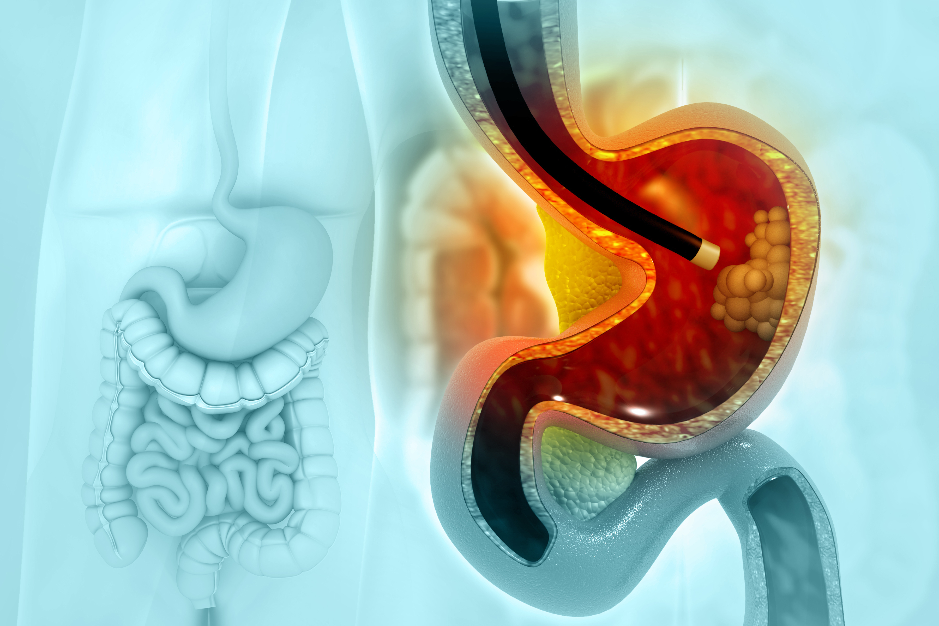 Stomach cancer, Cancer attacking cell, Endoscopy, 3d illustration