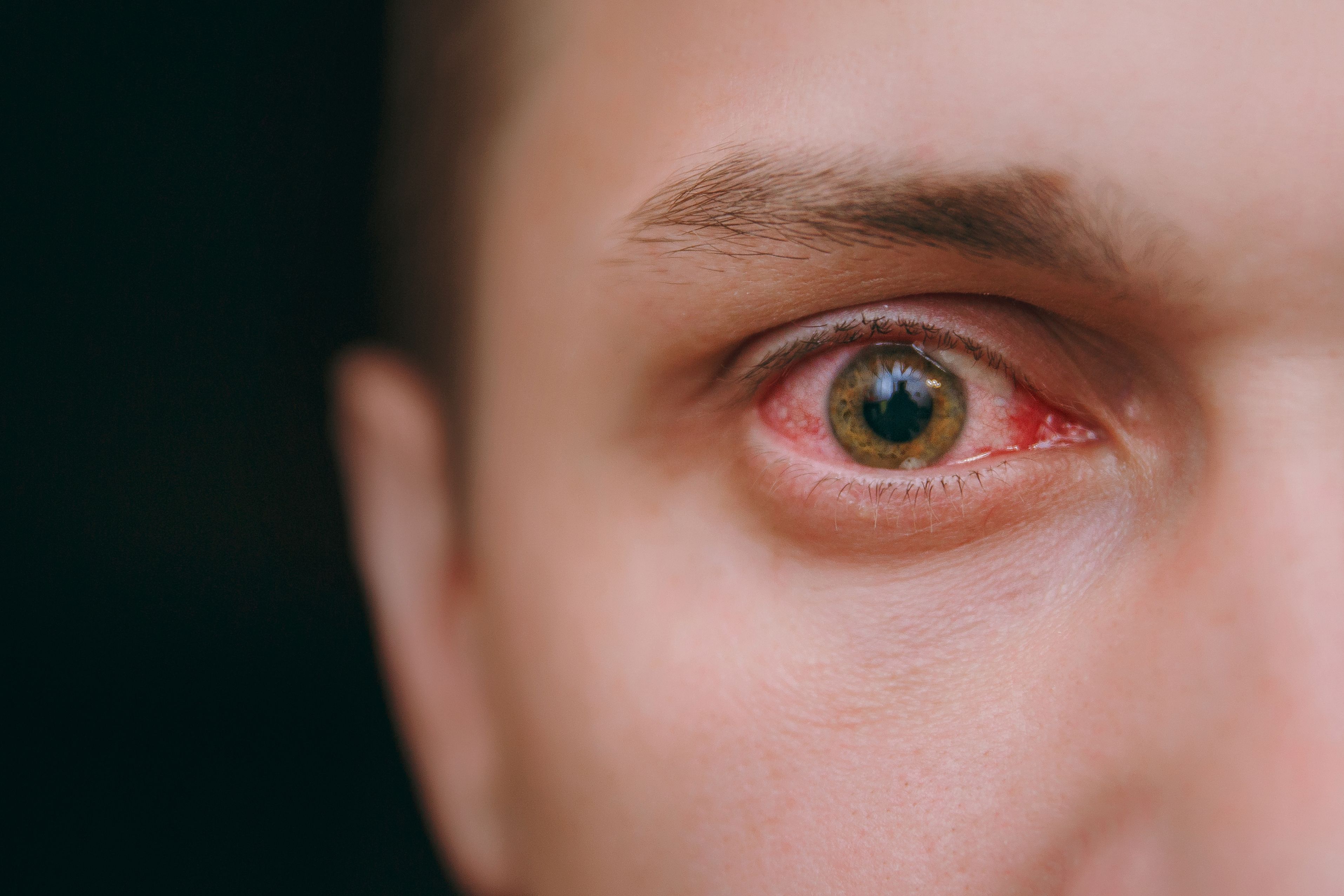 Close up of one annoyed red blood eye of a man affected by conjunctivitis