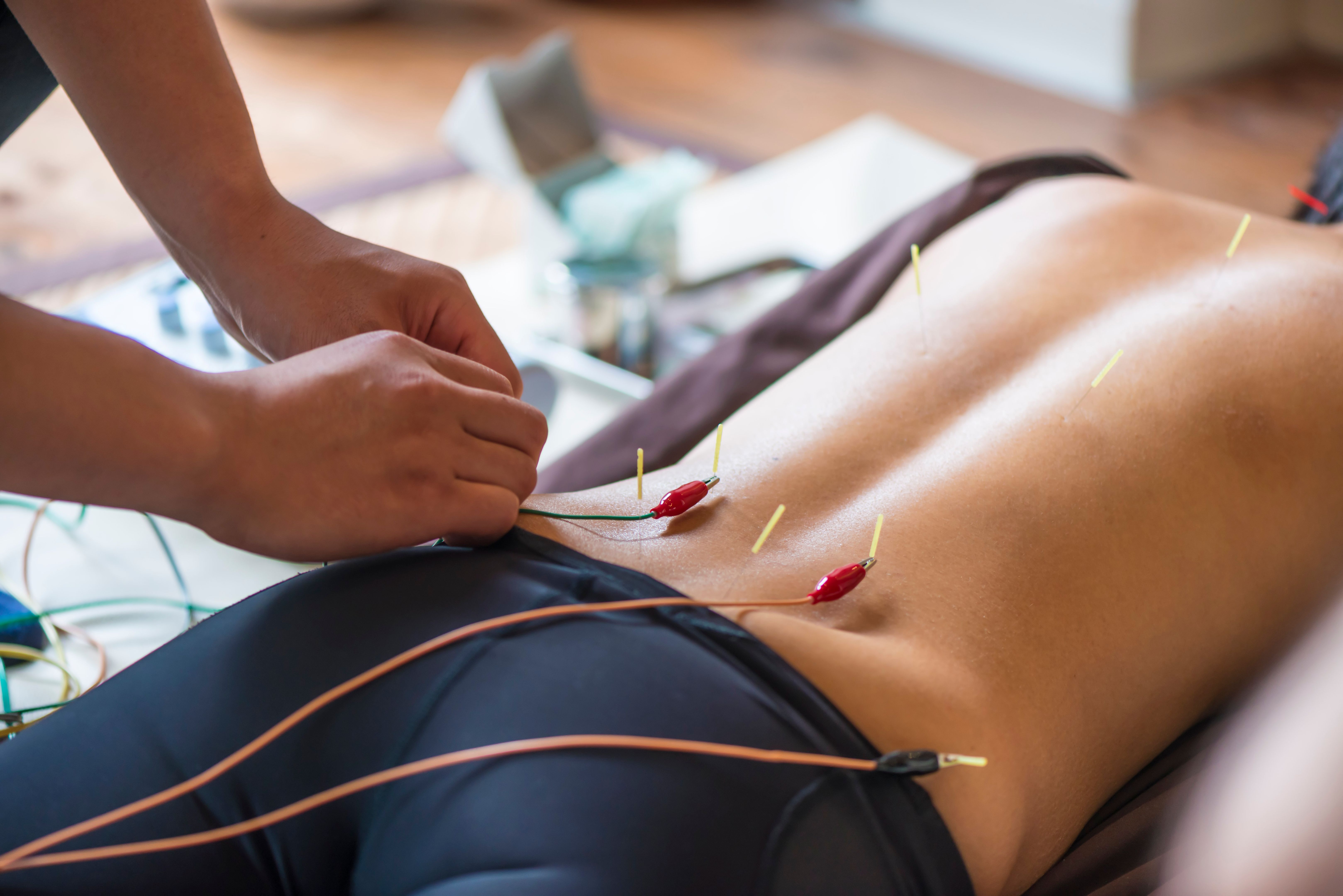 Young woman at the acupuncture treatment