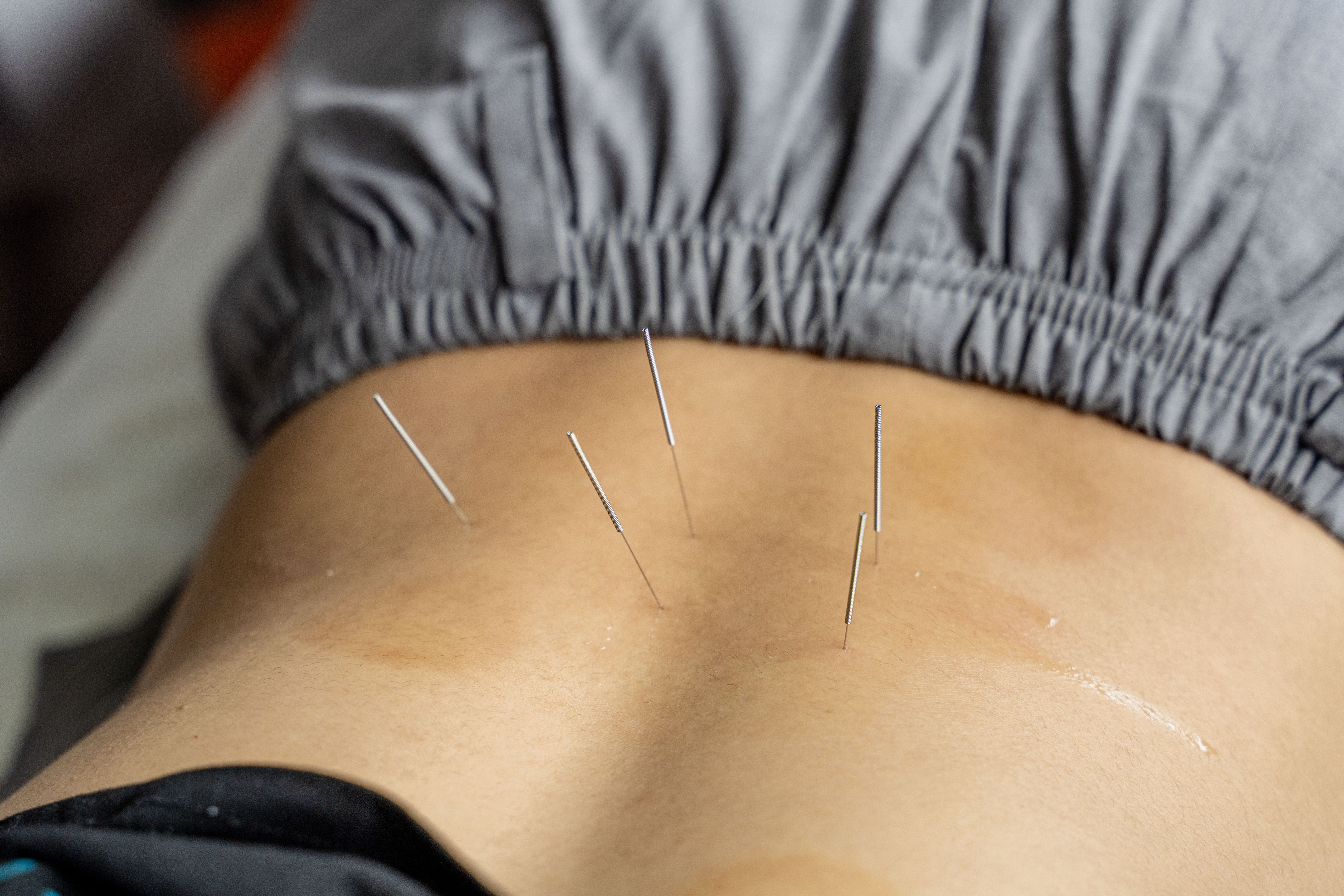 Traditional Chinese Medicine performs acupuncture treatment on the back of a person Traditional Chinese Medicine performs acupuncture treatment on the back of a person