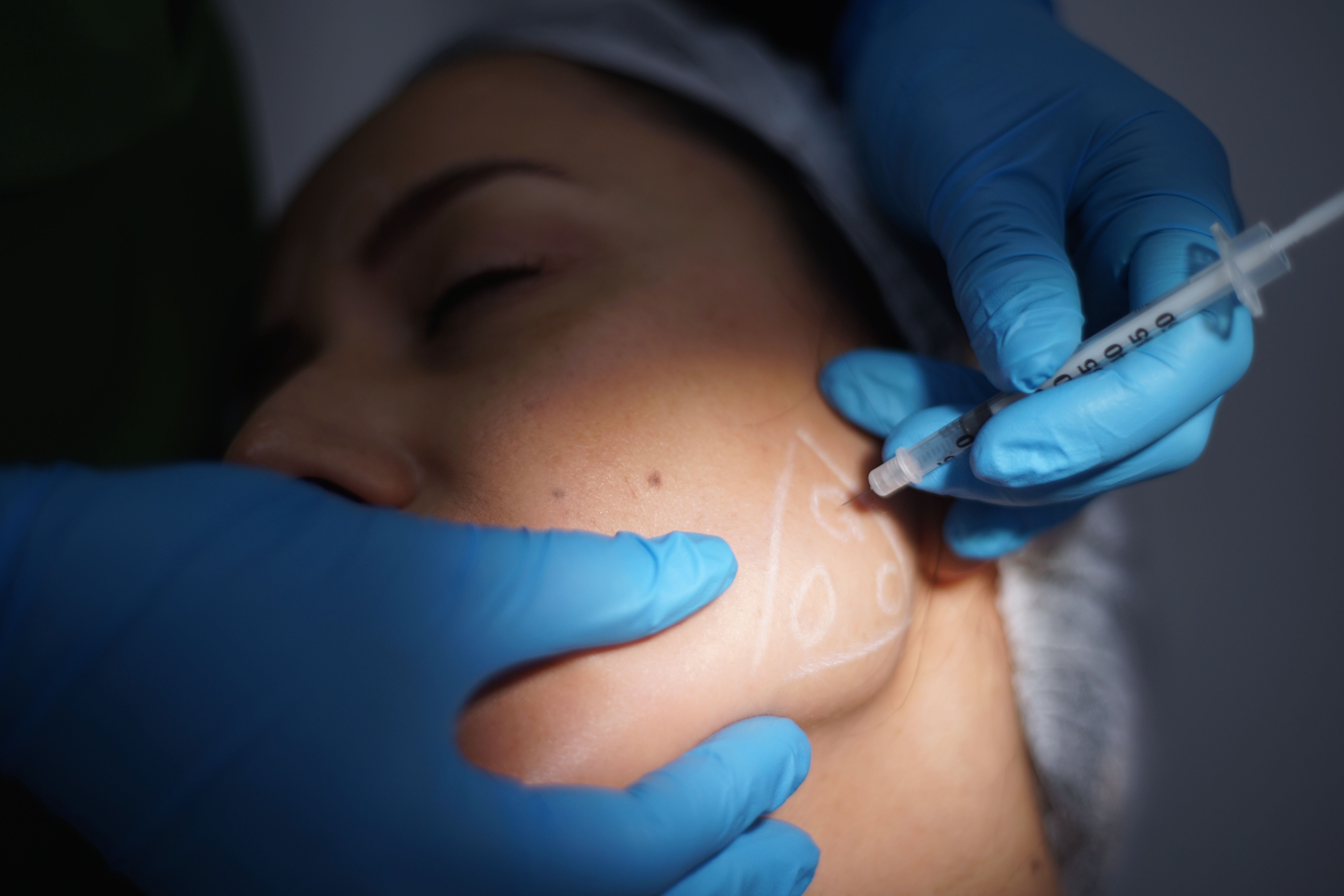 botulinum toxin