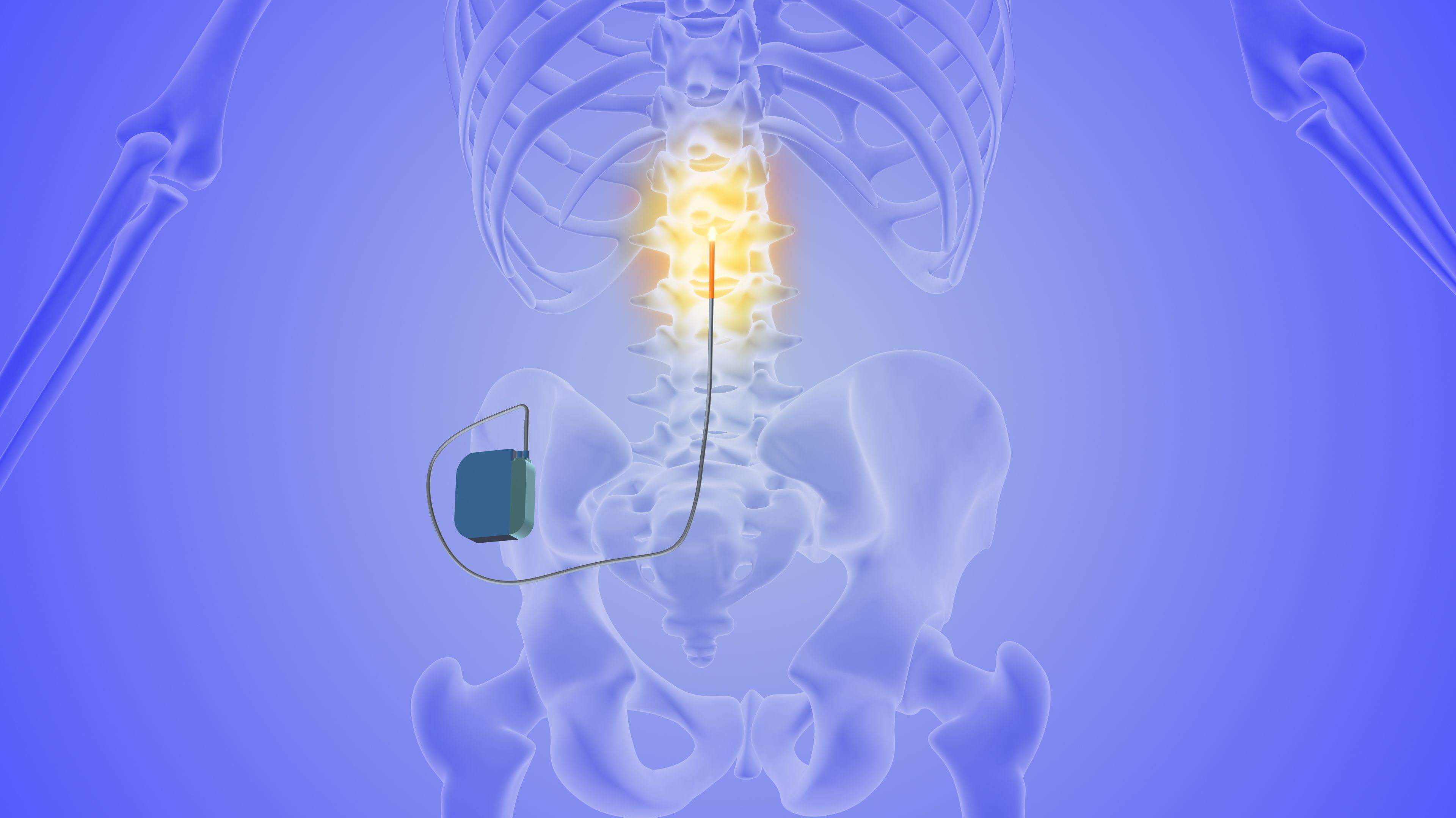 spinal cord stimulation