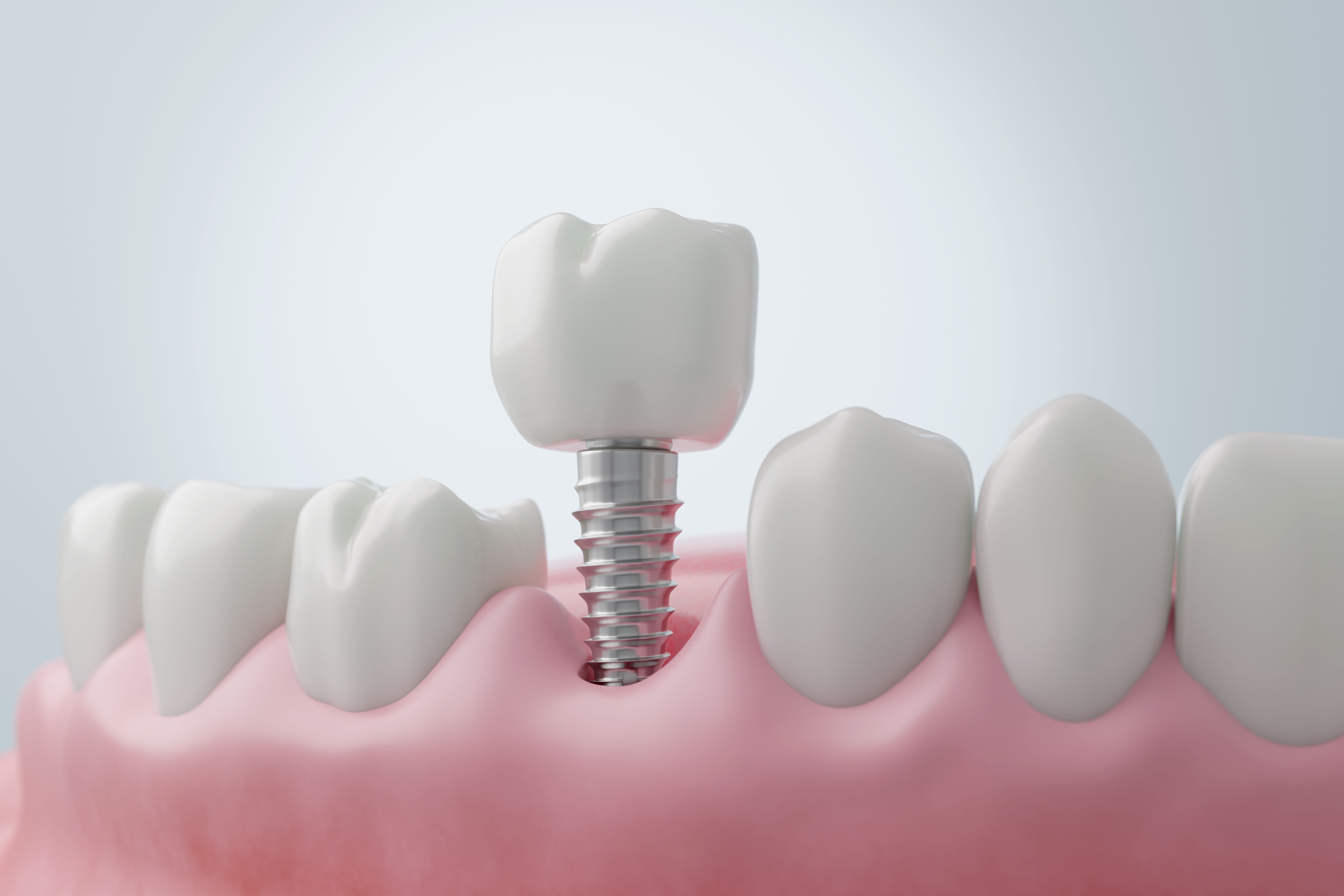 dental implant procedure