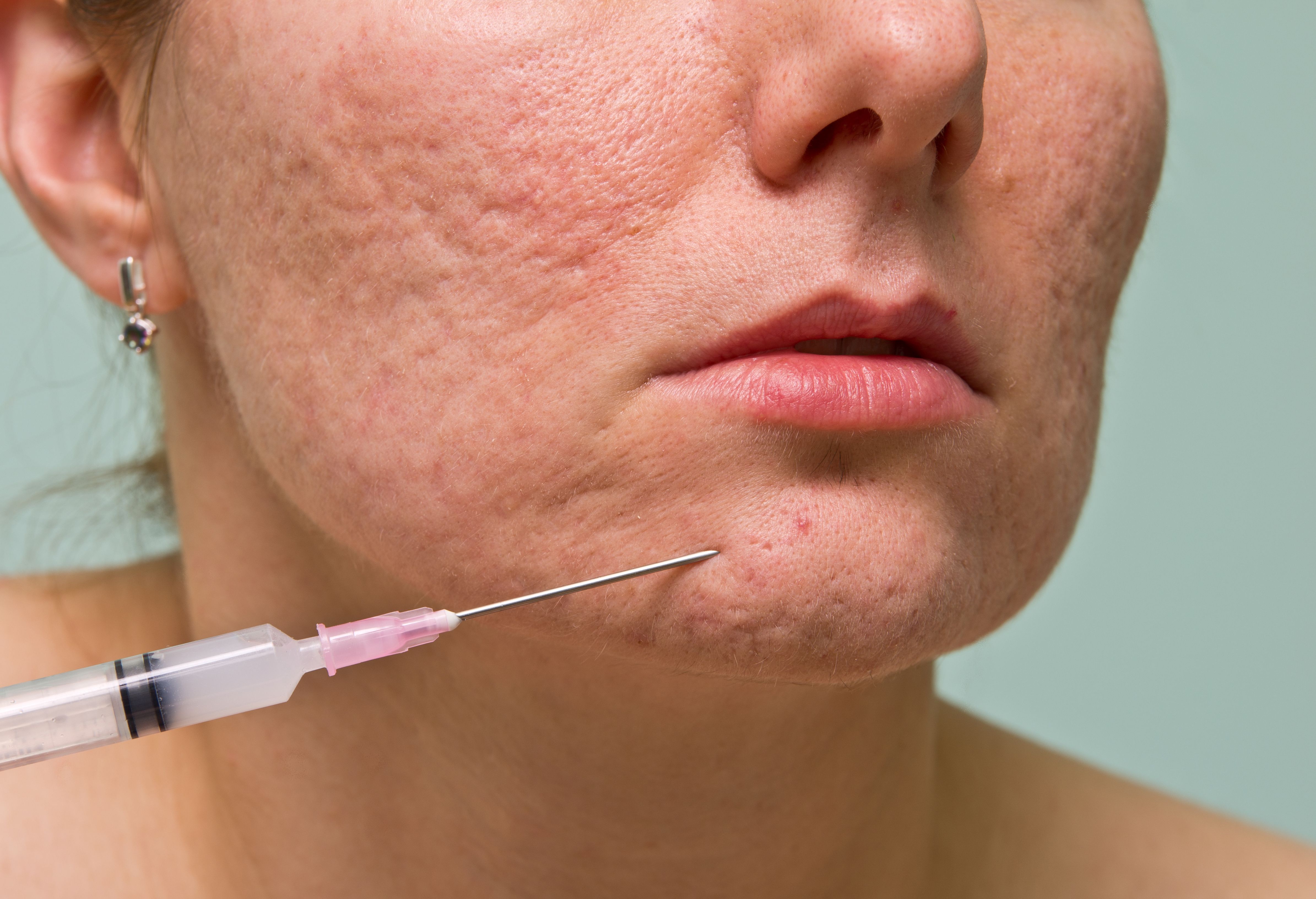 acne scar treatment prp leicester skin hair acne scar treatment prp leicester skin hair