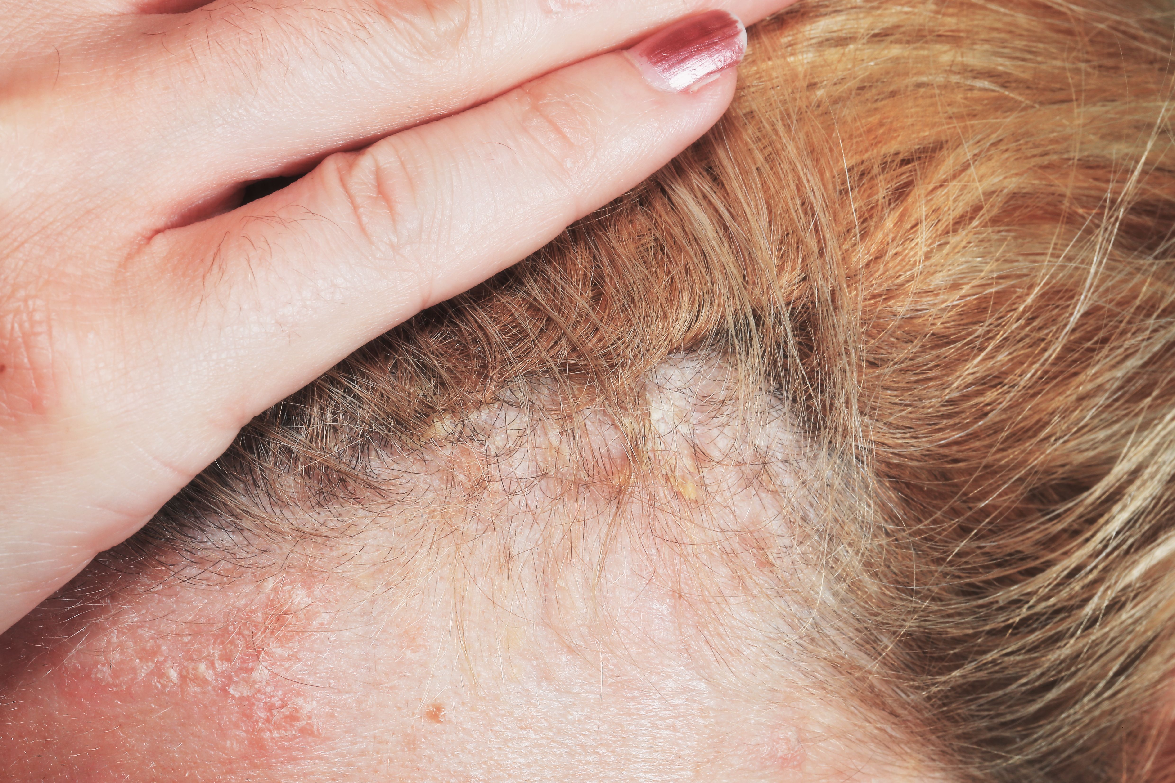 scalp psoriasis