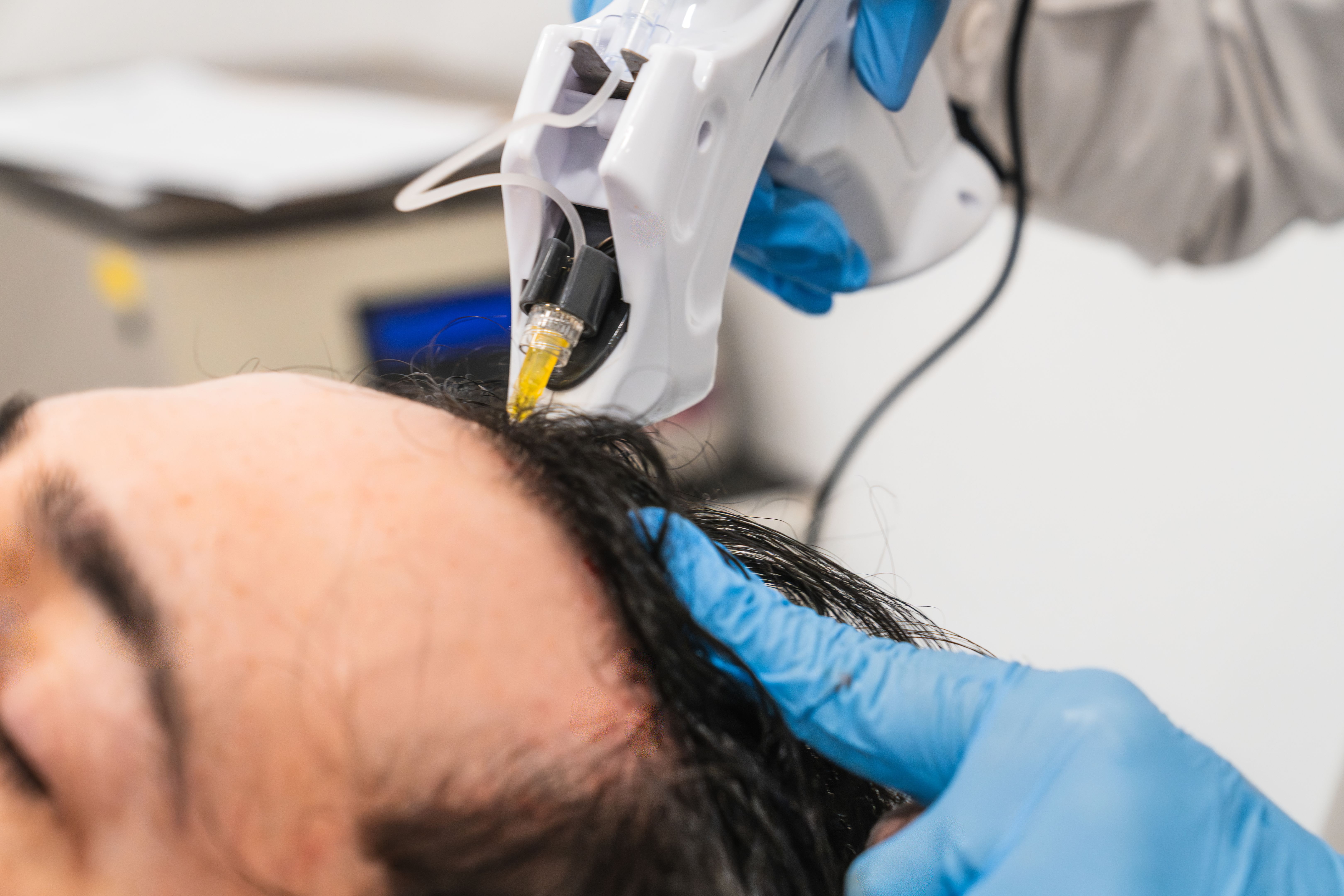 hair transplant surgery