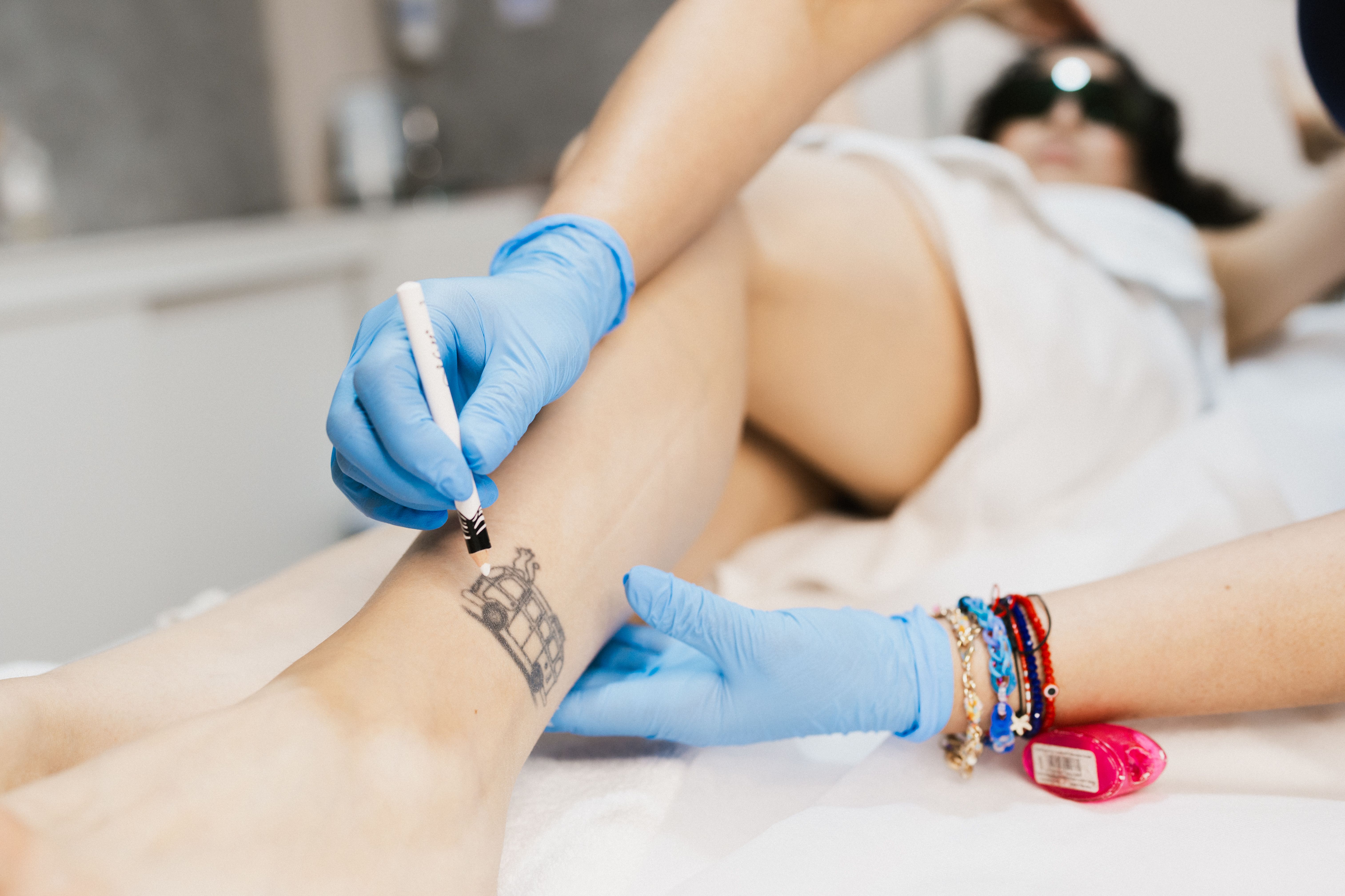 laser tattoo removal