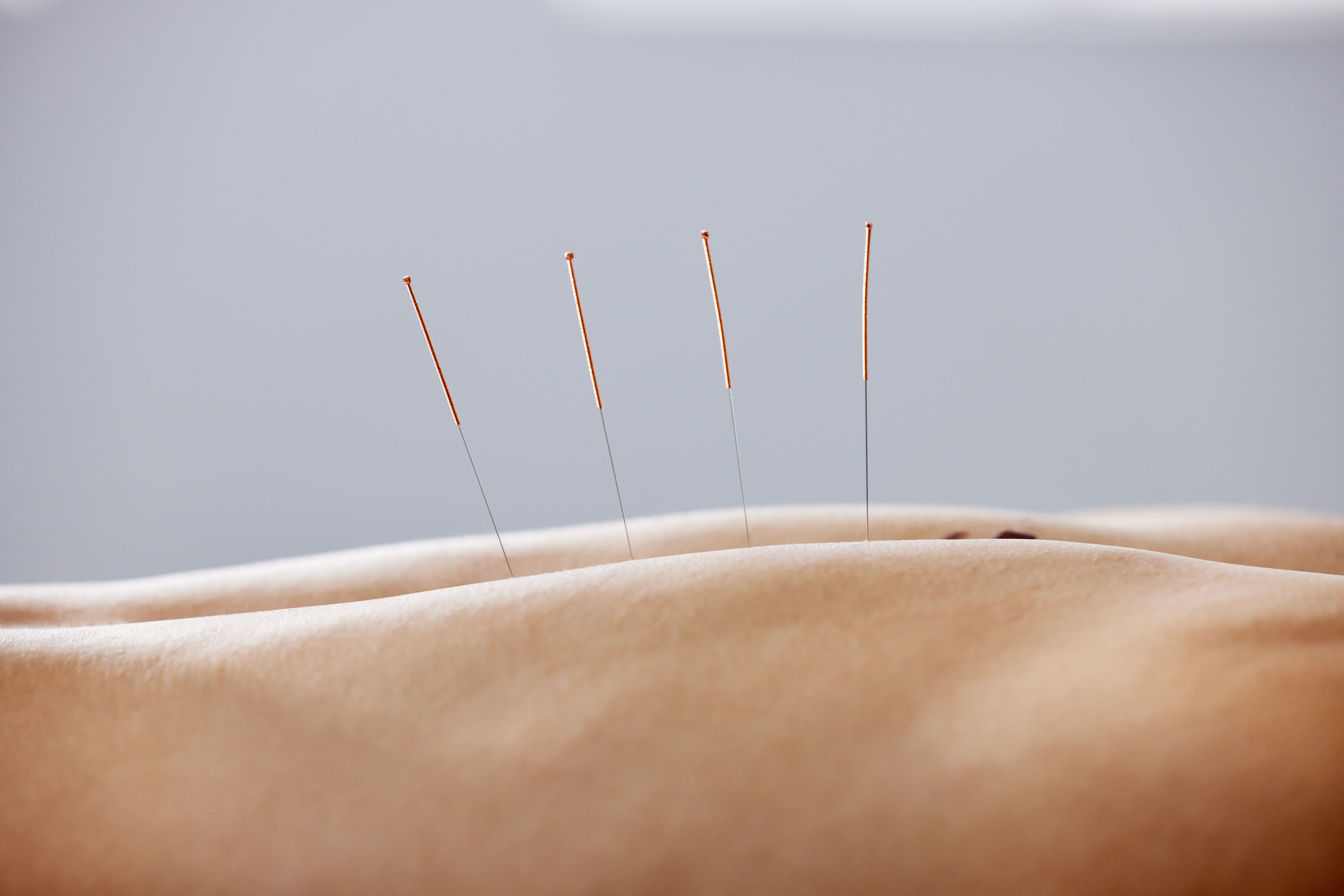 acupuncture needles