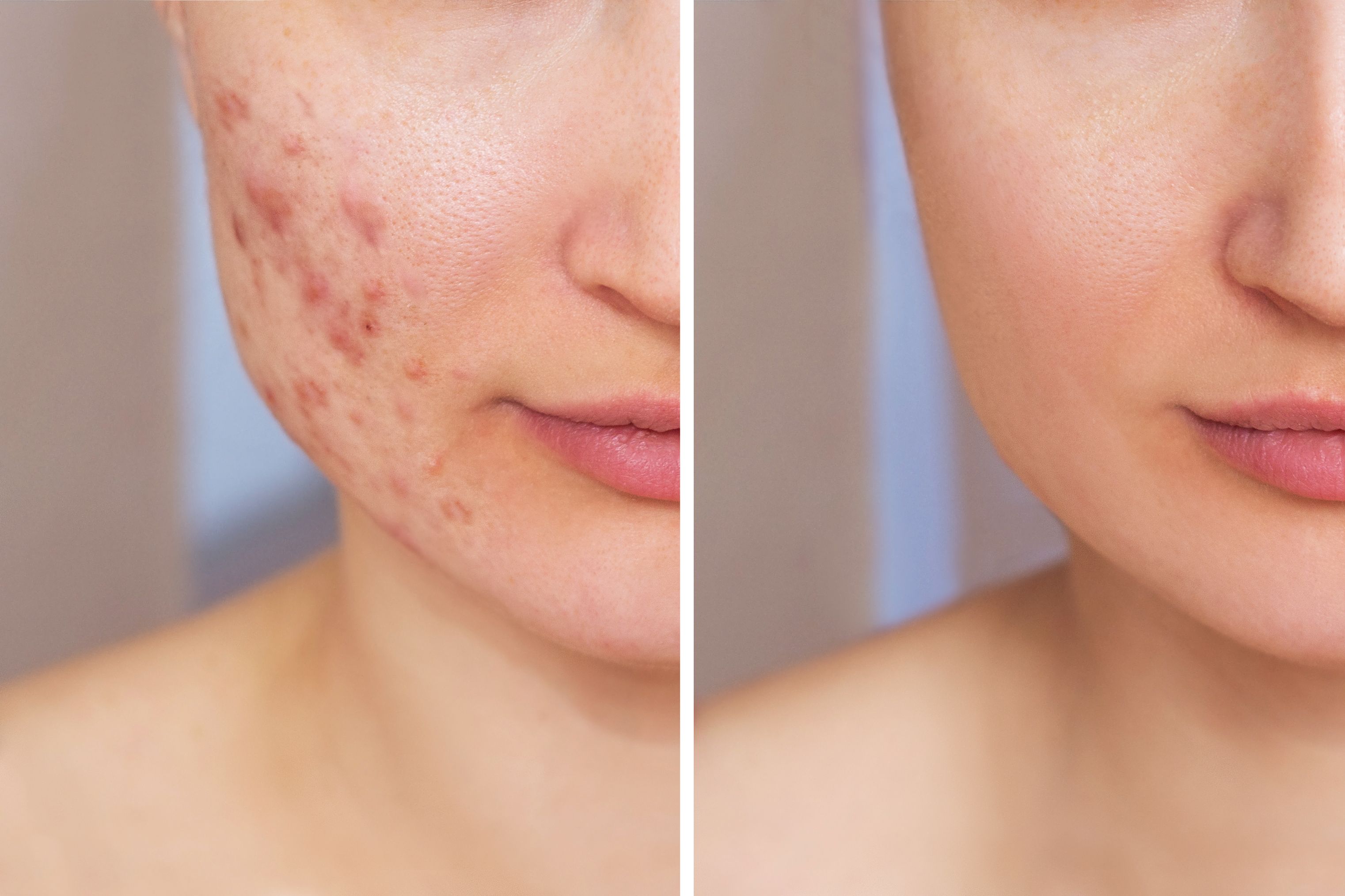 before after acne