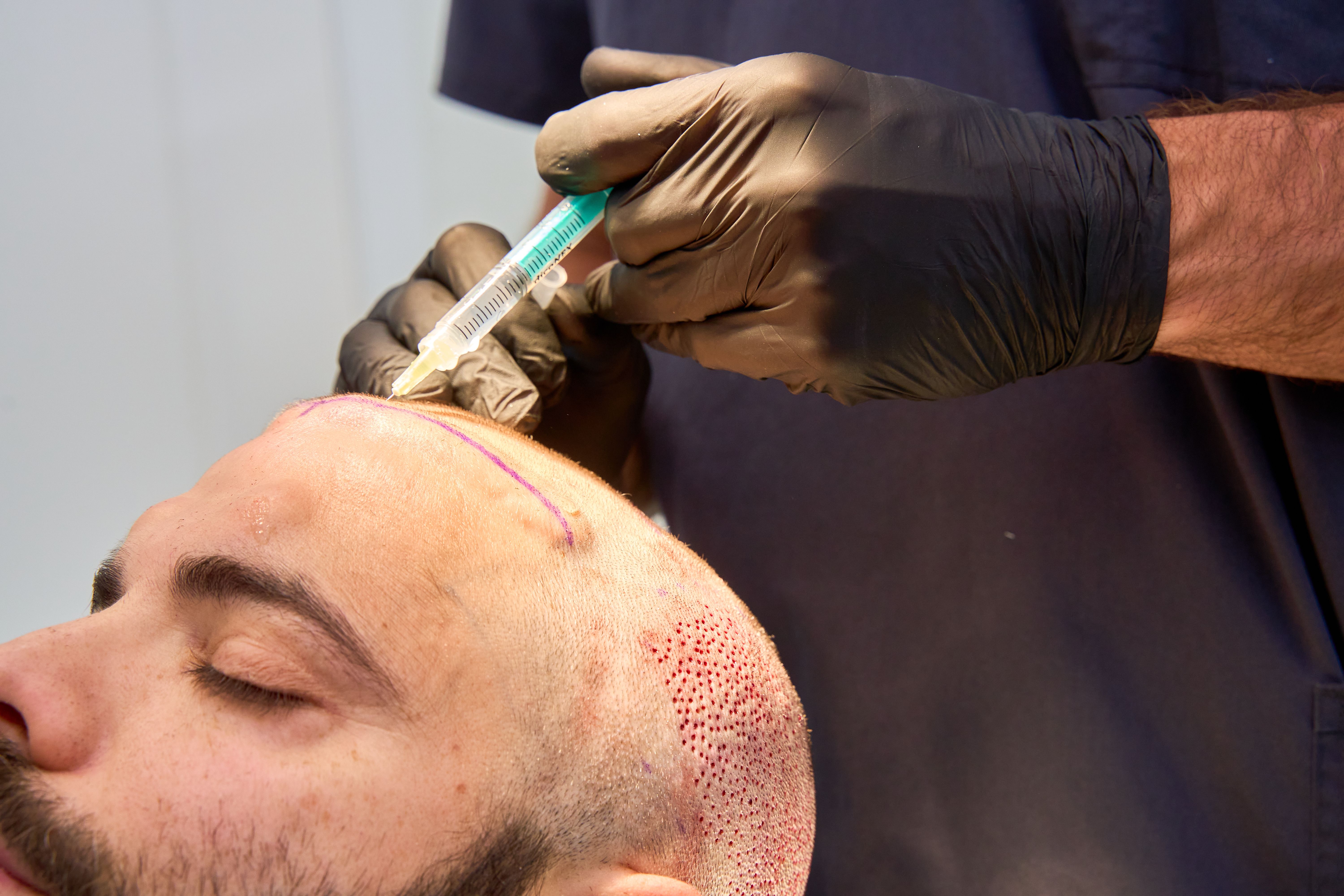 post hair transplant care
