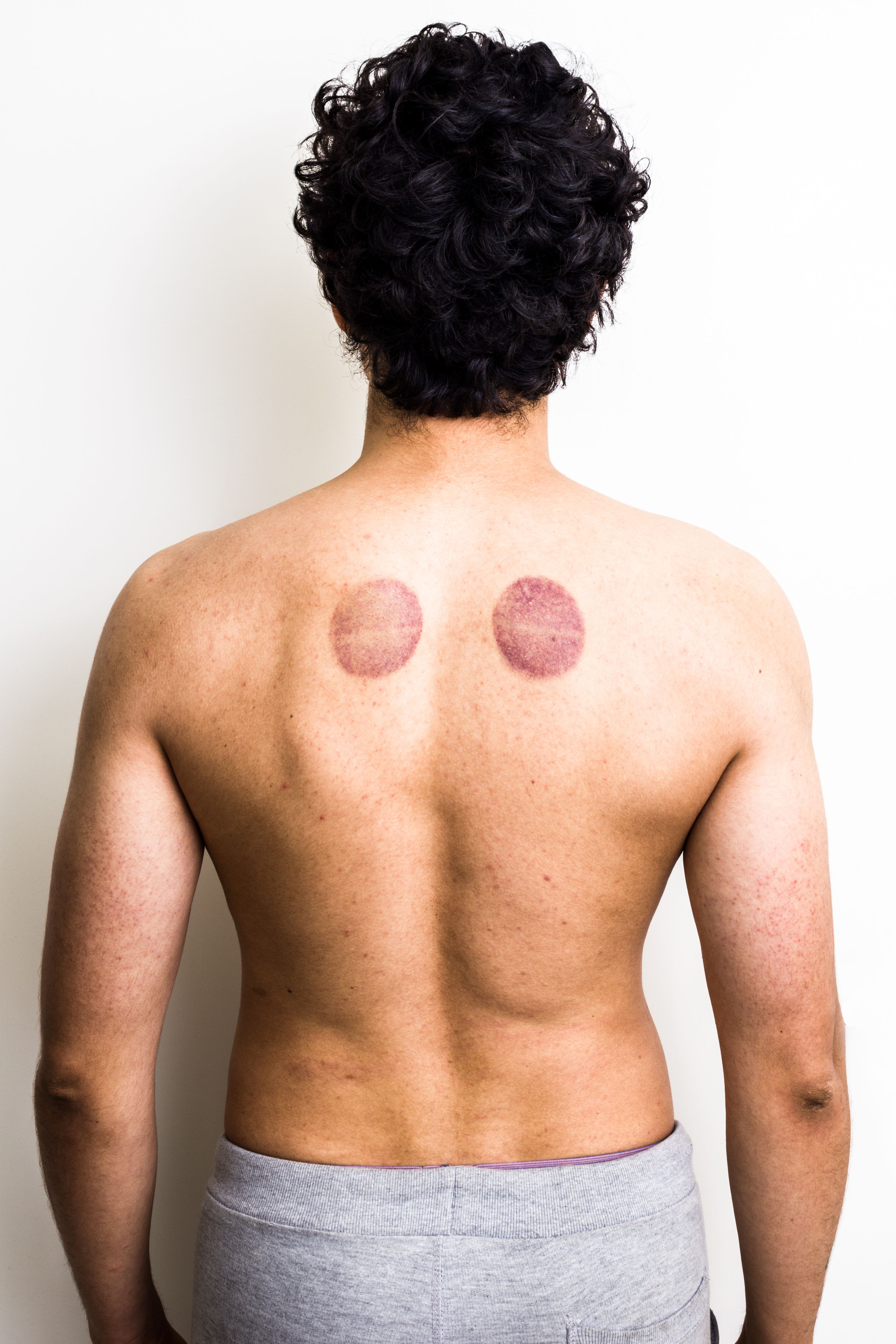 cupping marks