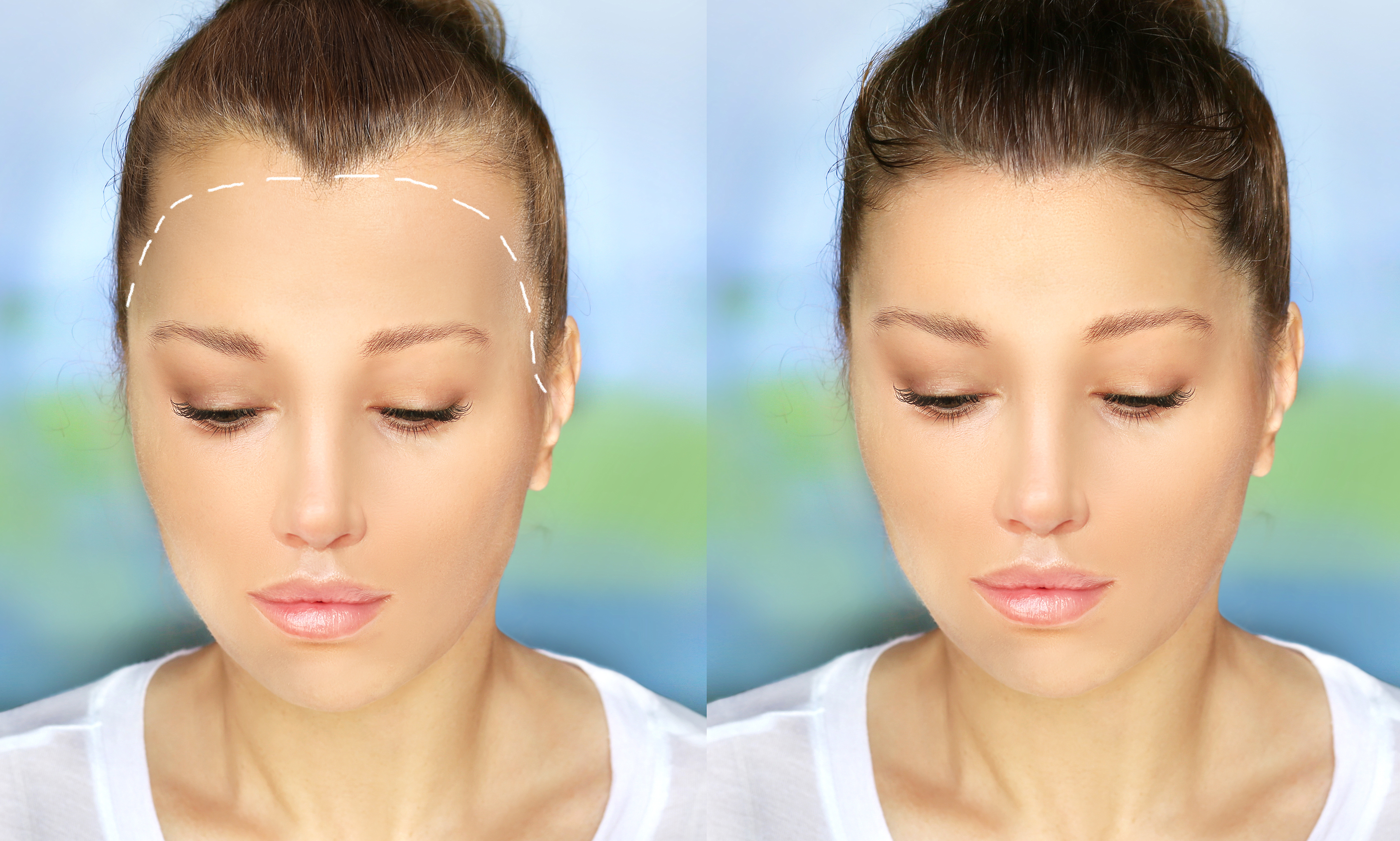 Alopecia Areata,female pattern baldness,Treatment for hair loss,Hair transplant,Surgery to implant artificial hairs