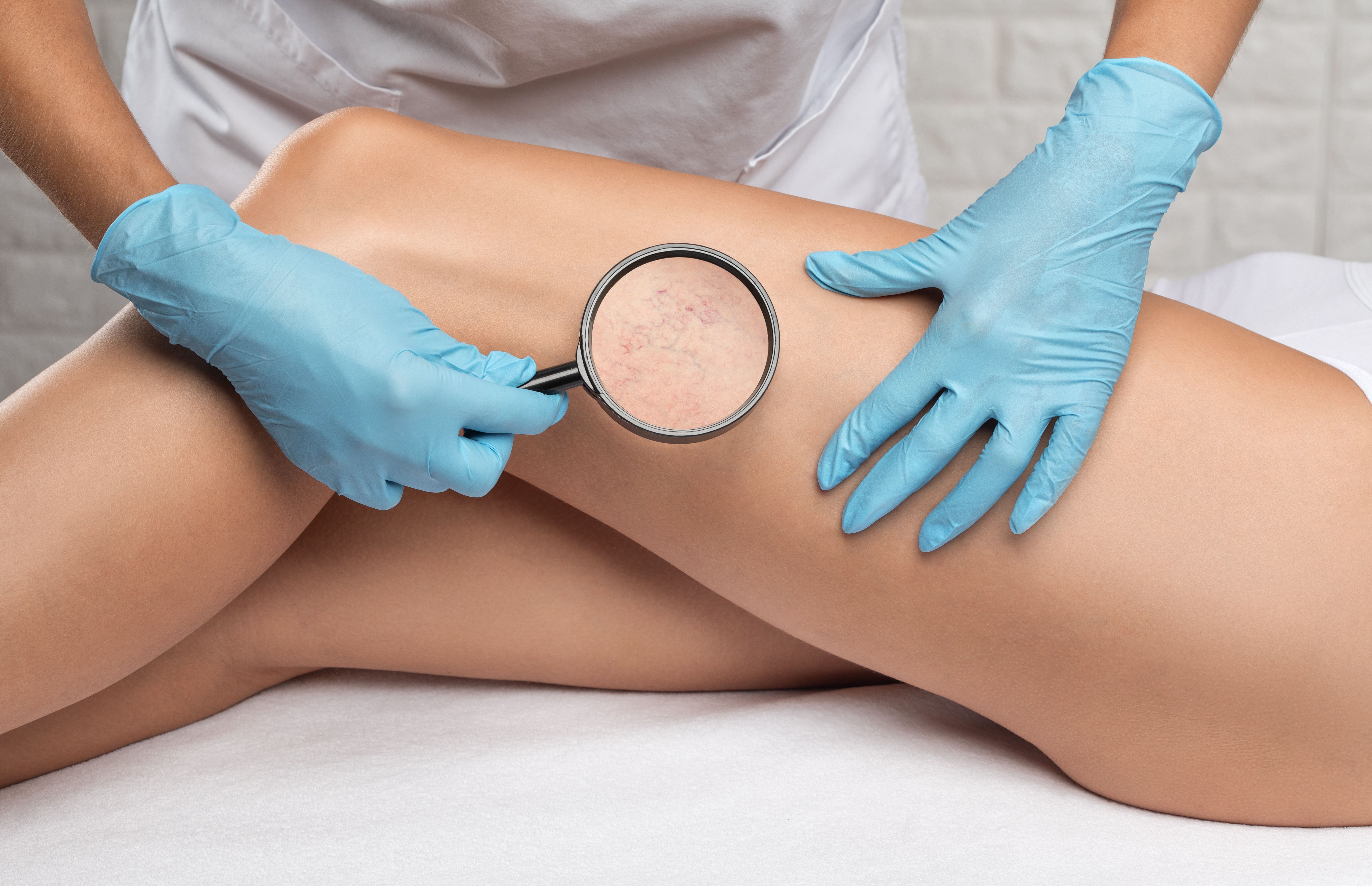 sclerotherapy treatment