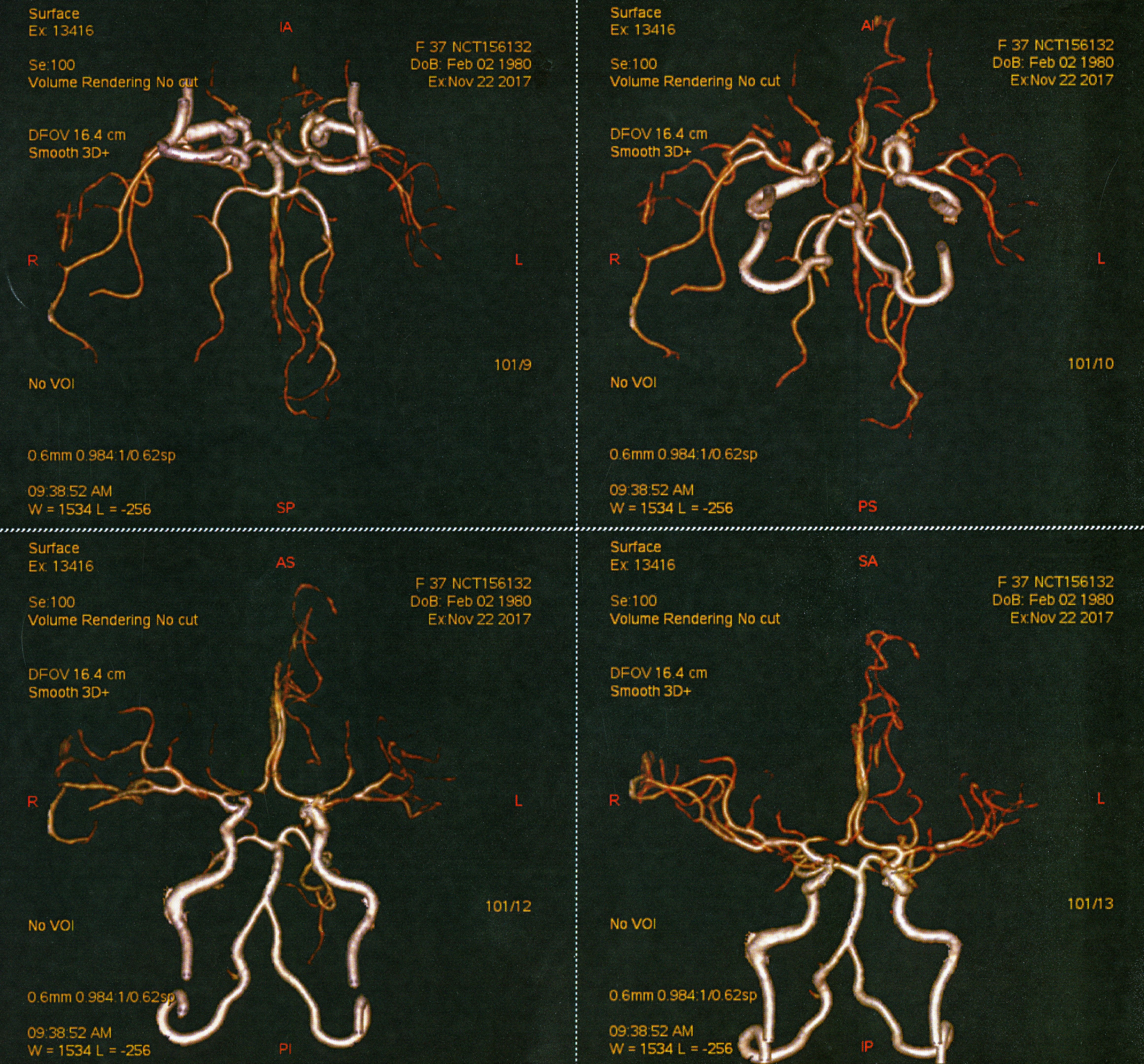 Stenting Iih Stenting of Dural Venous Sinuses in Idiopathic Intracranial ...