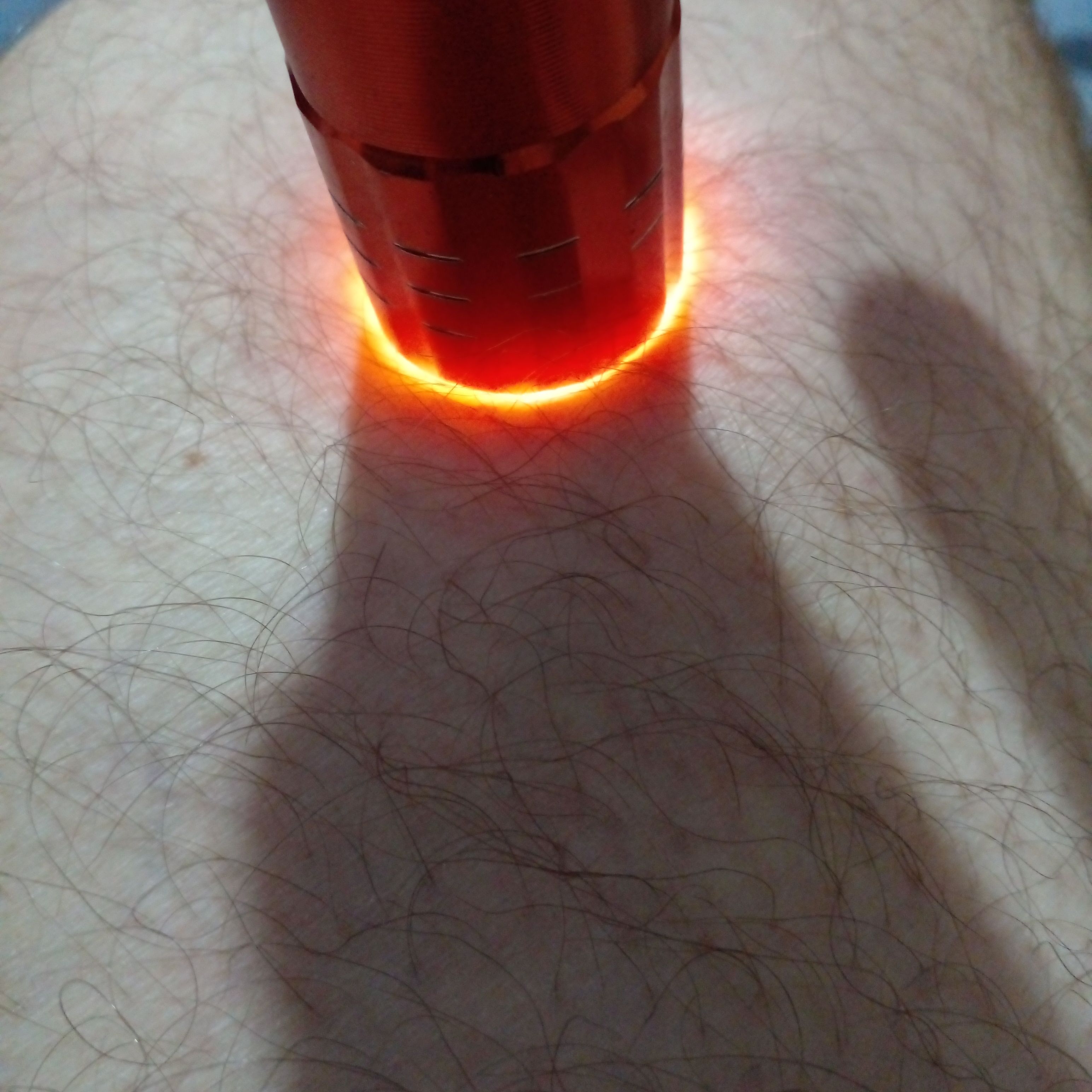 laser varizes tratamento