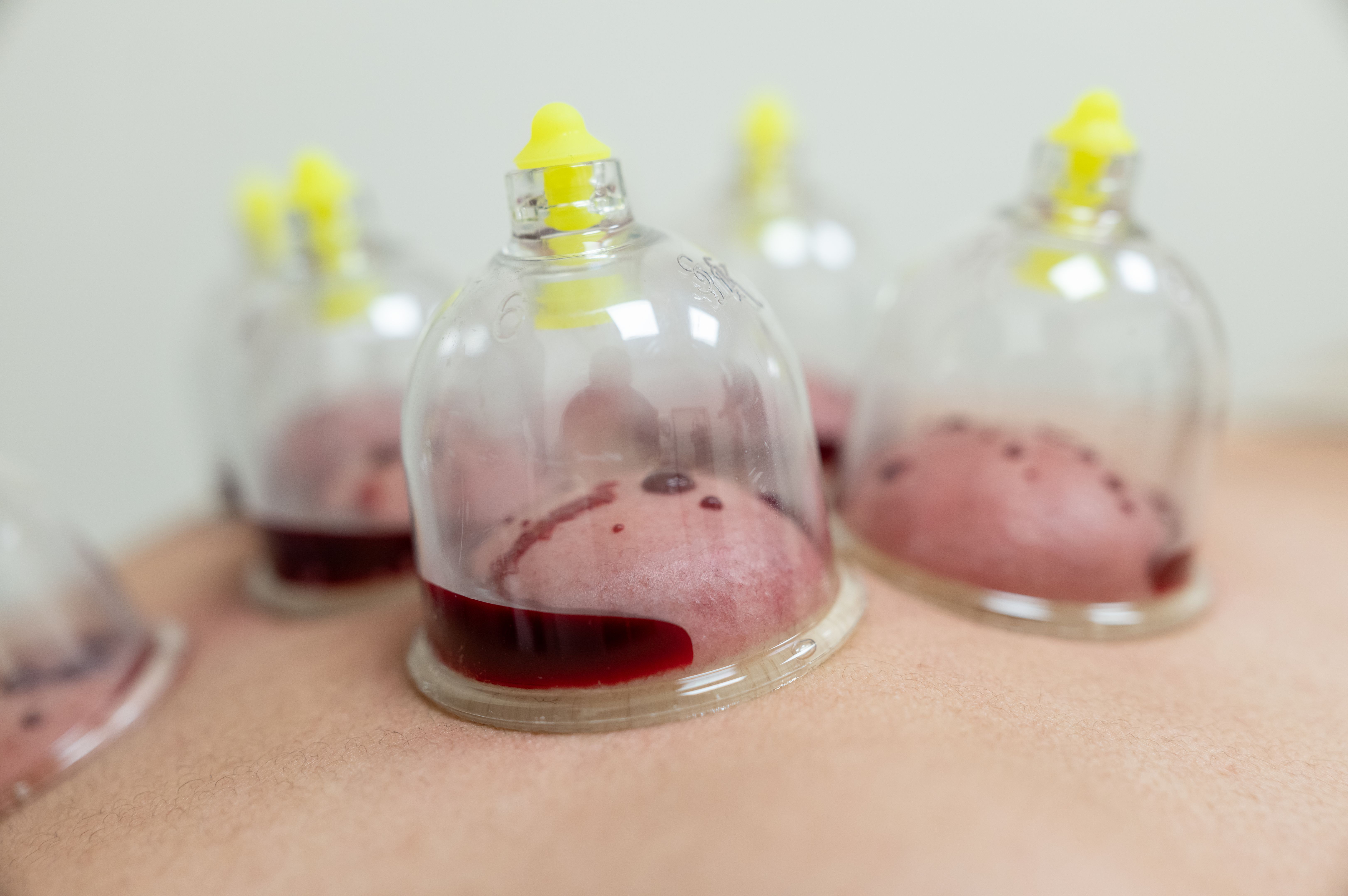 Patient receiving cupping therapy on back for pain relief Patient receiving cupping therapy on back for pain relief