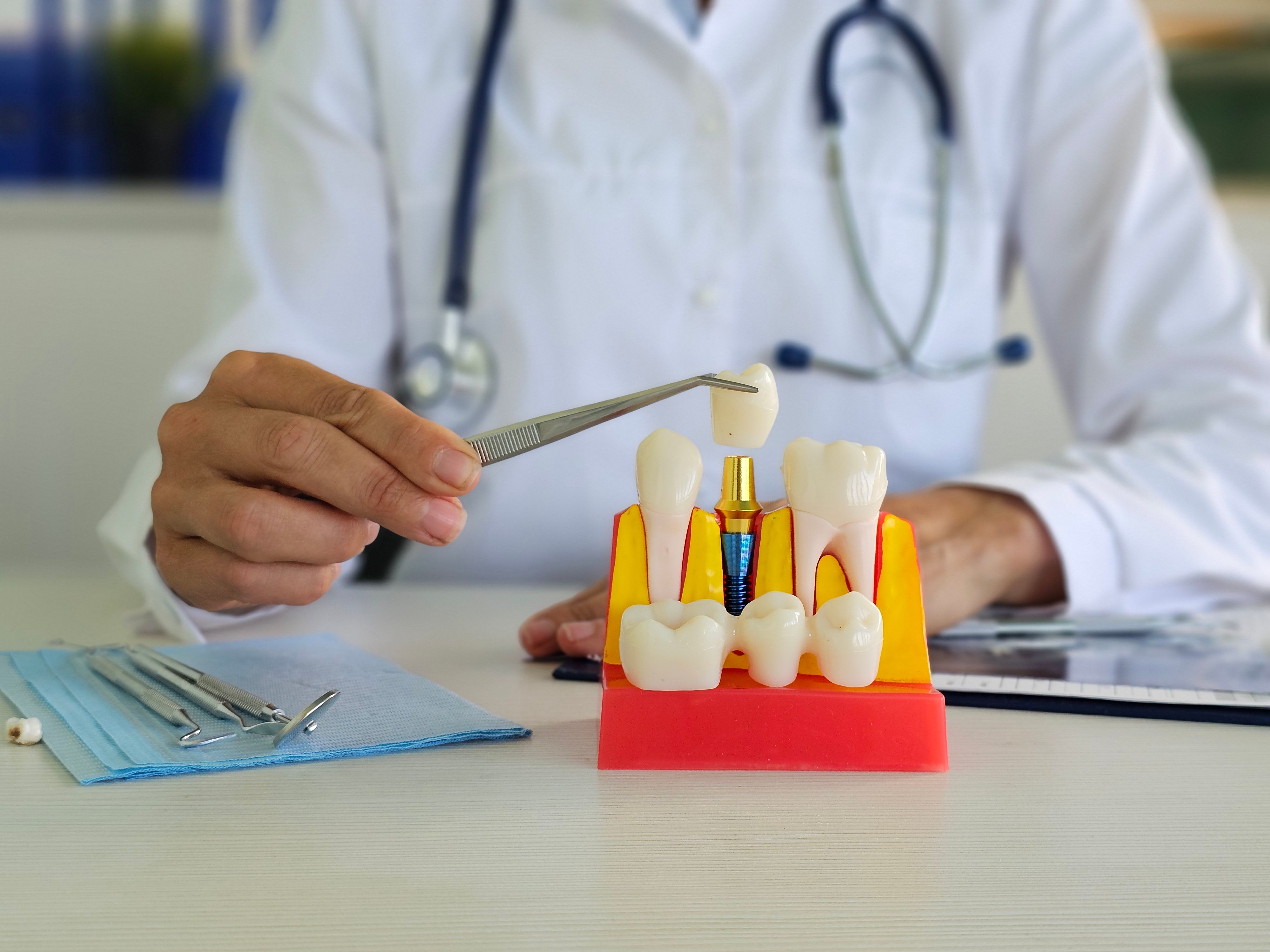 dental implants