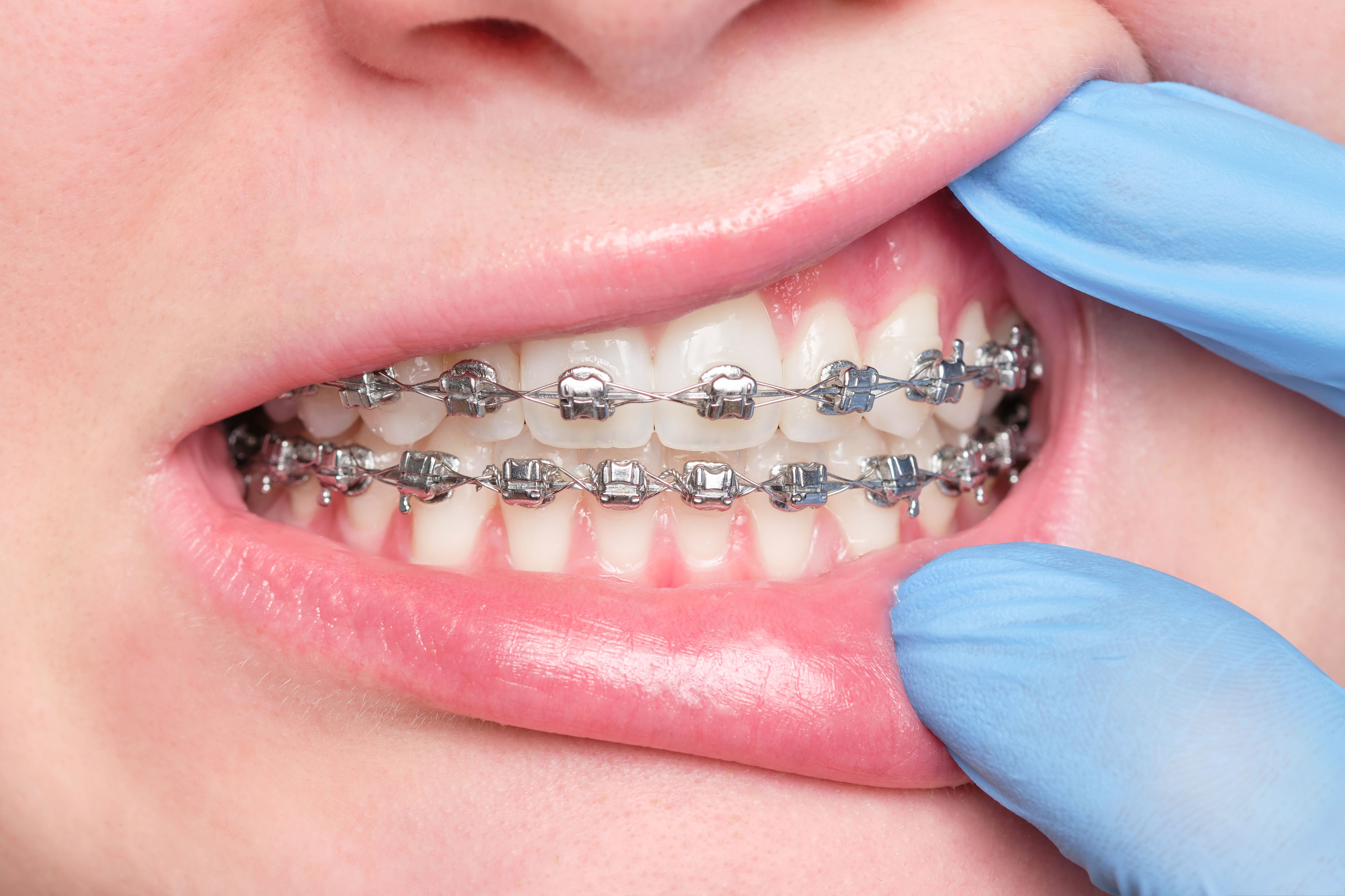 braces heat protection