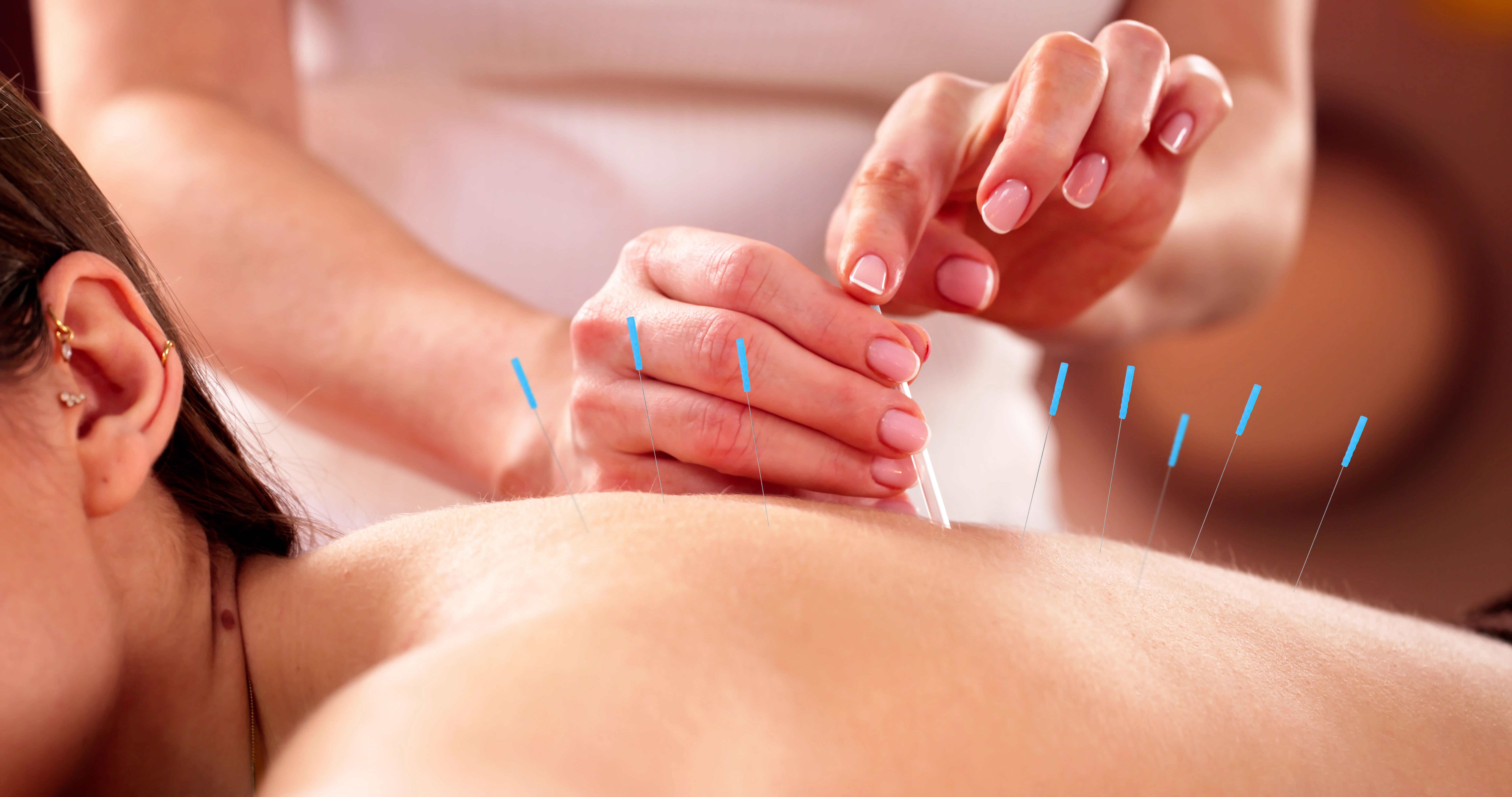acupuncture therapy