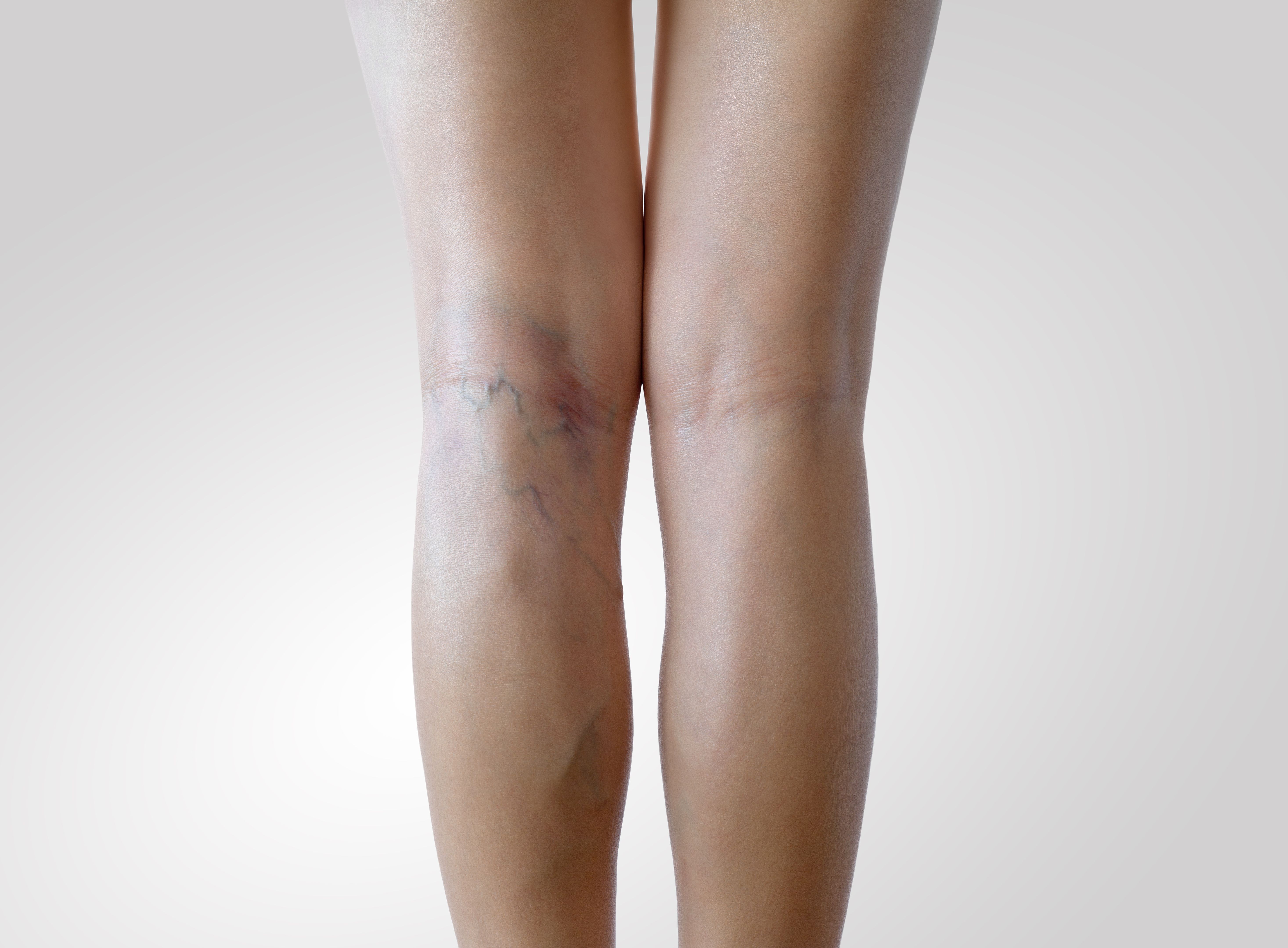varicose veins treatment