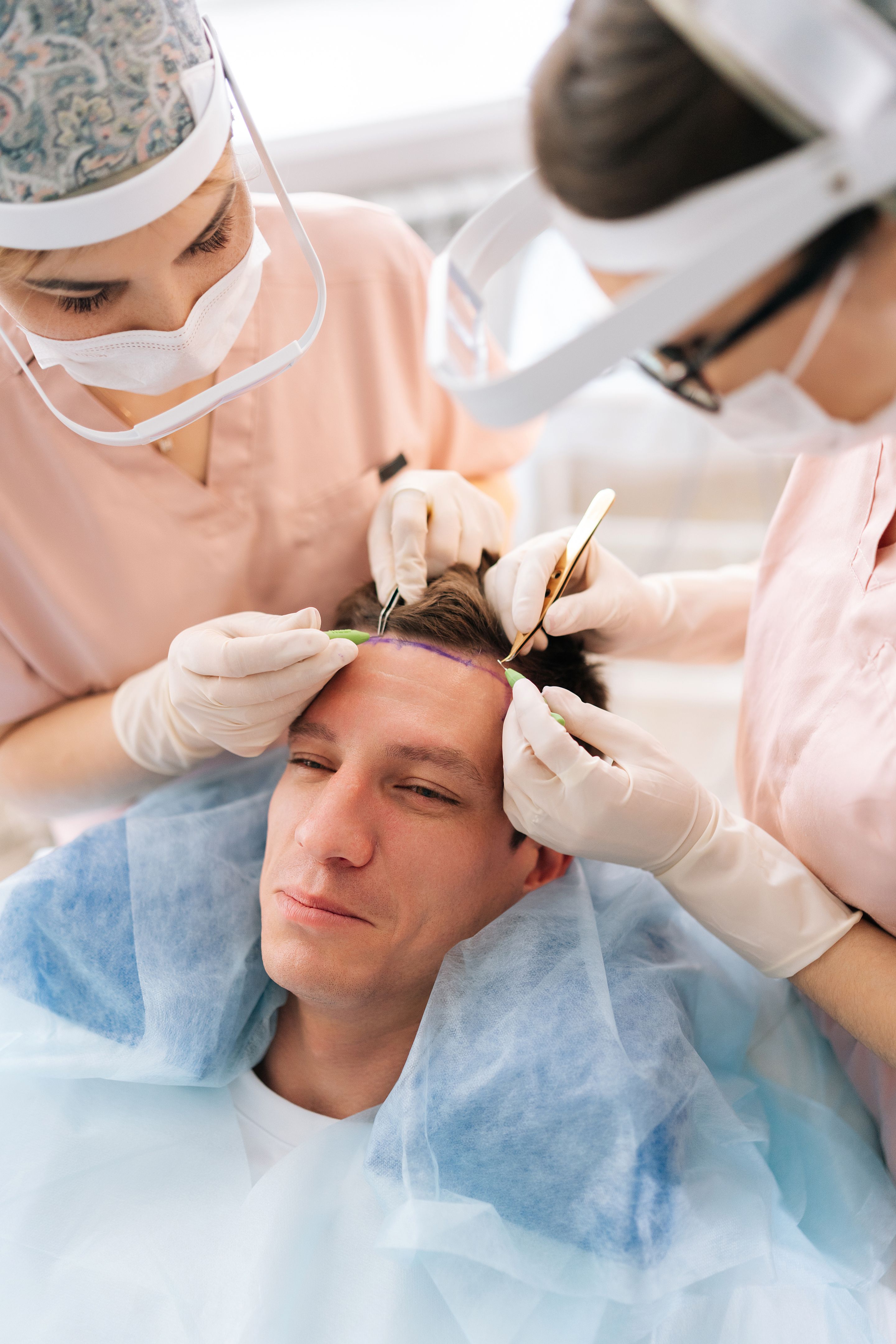 hair transplant process