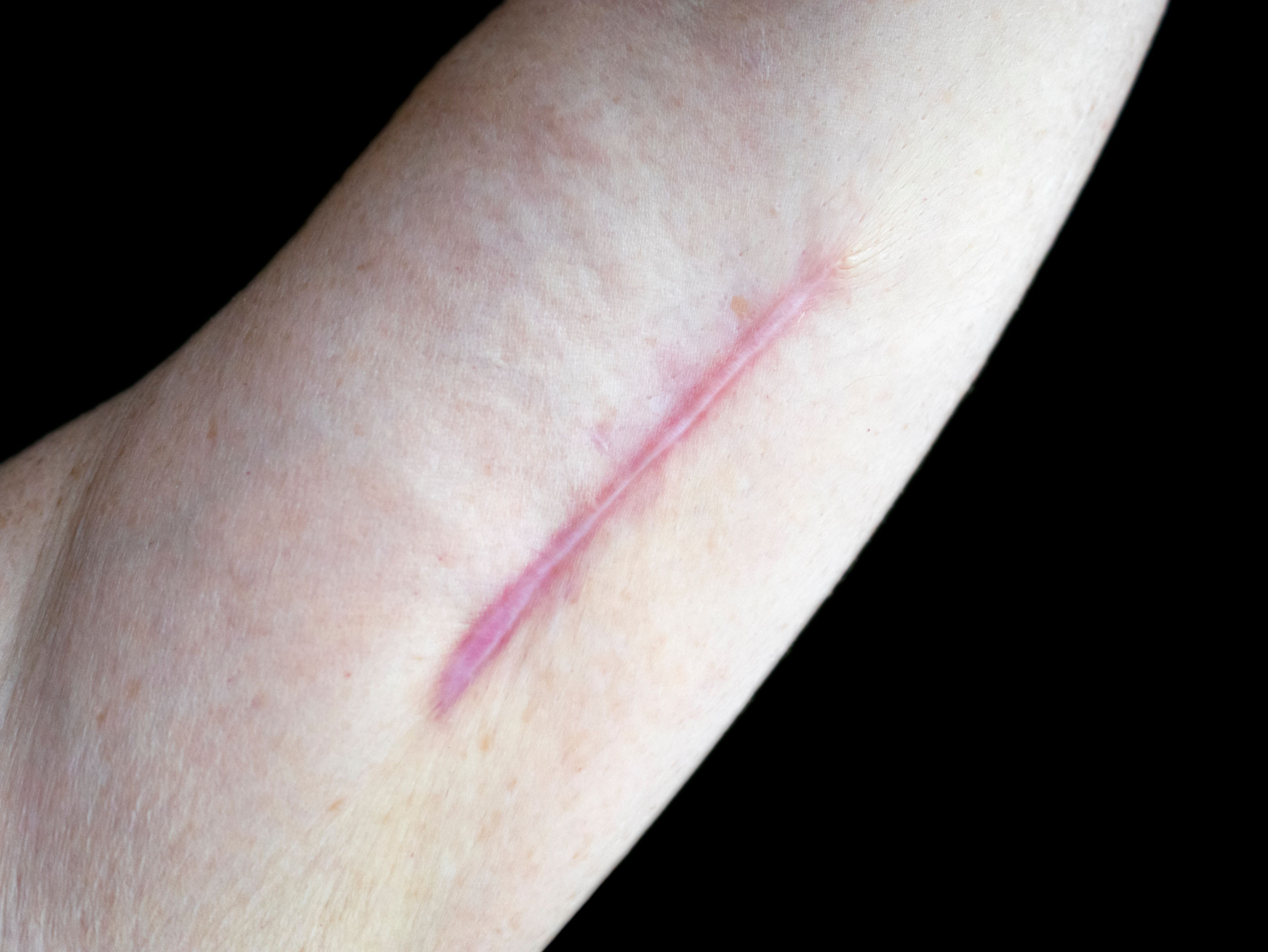 Keloid scar on a senior woman's arm Keloid scar on a senior woman's arm