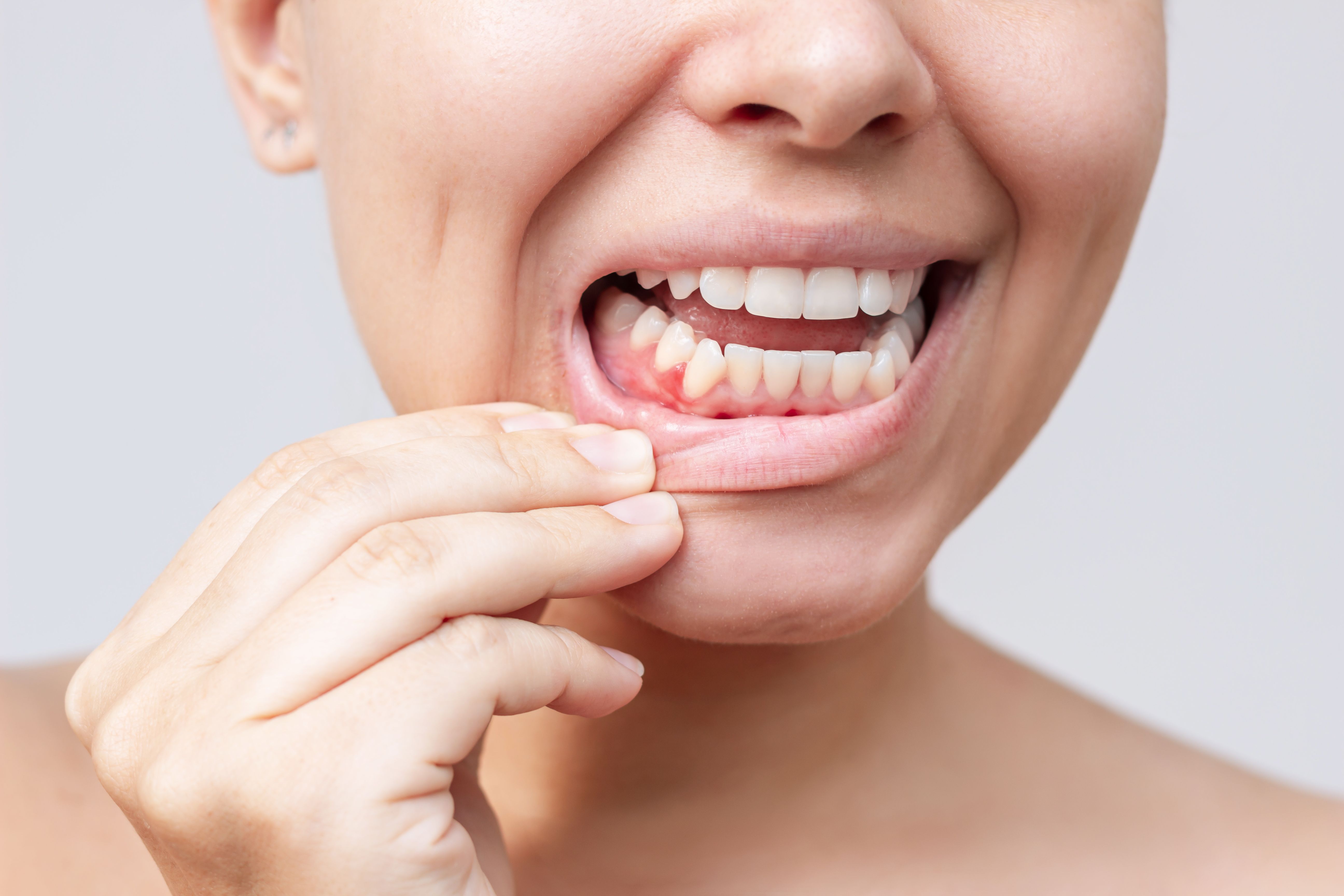 gum disease