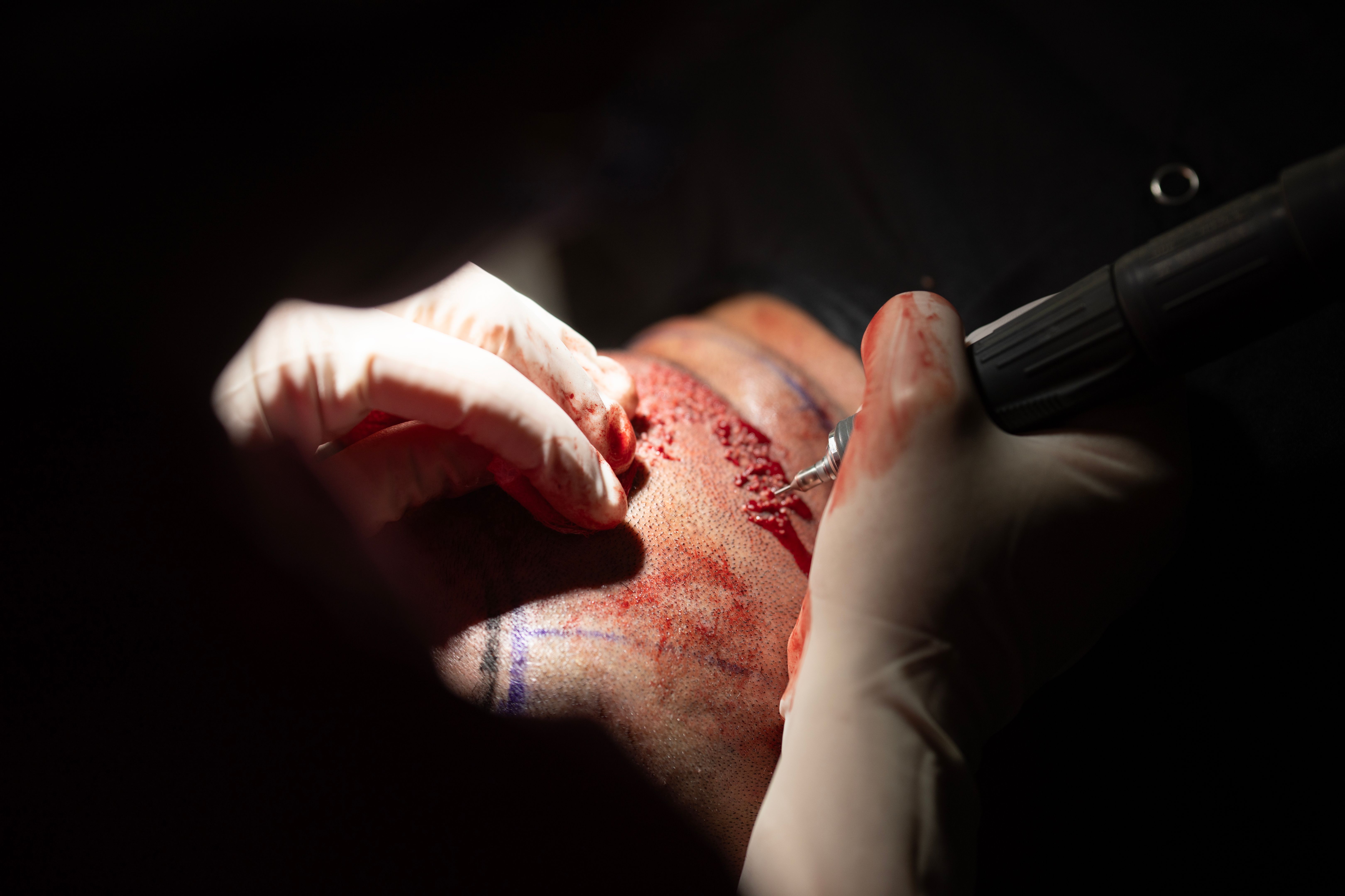 stem cell therapy hair