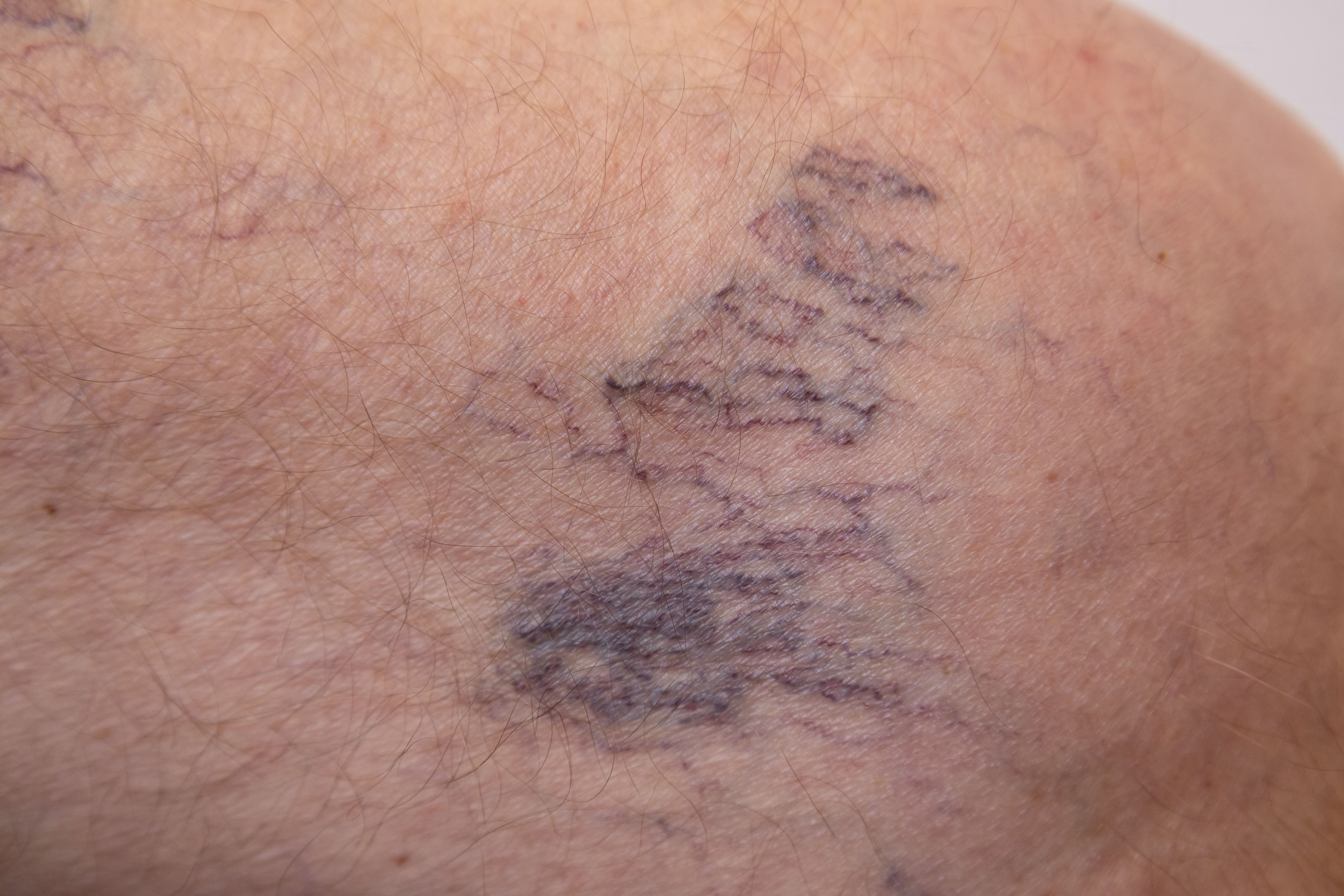 varicose veins