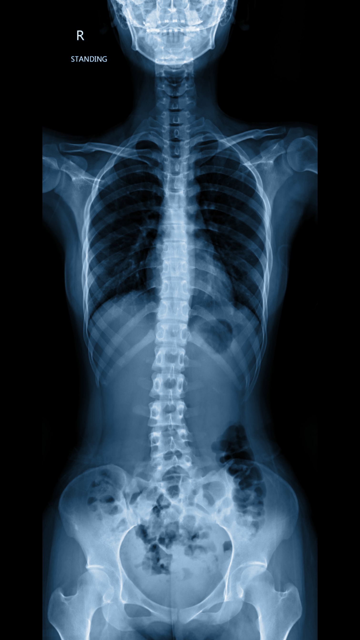 spinal x-ray