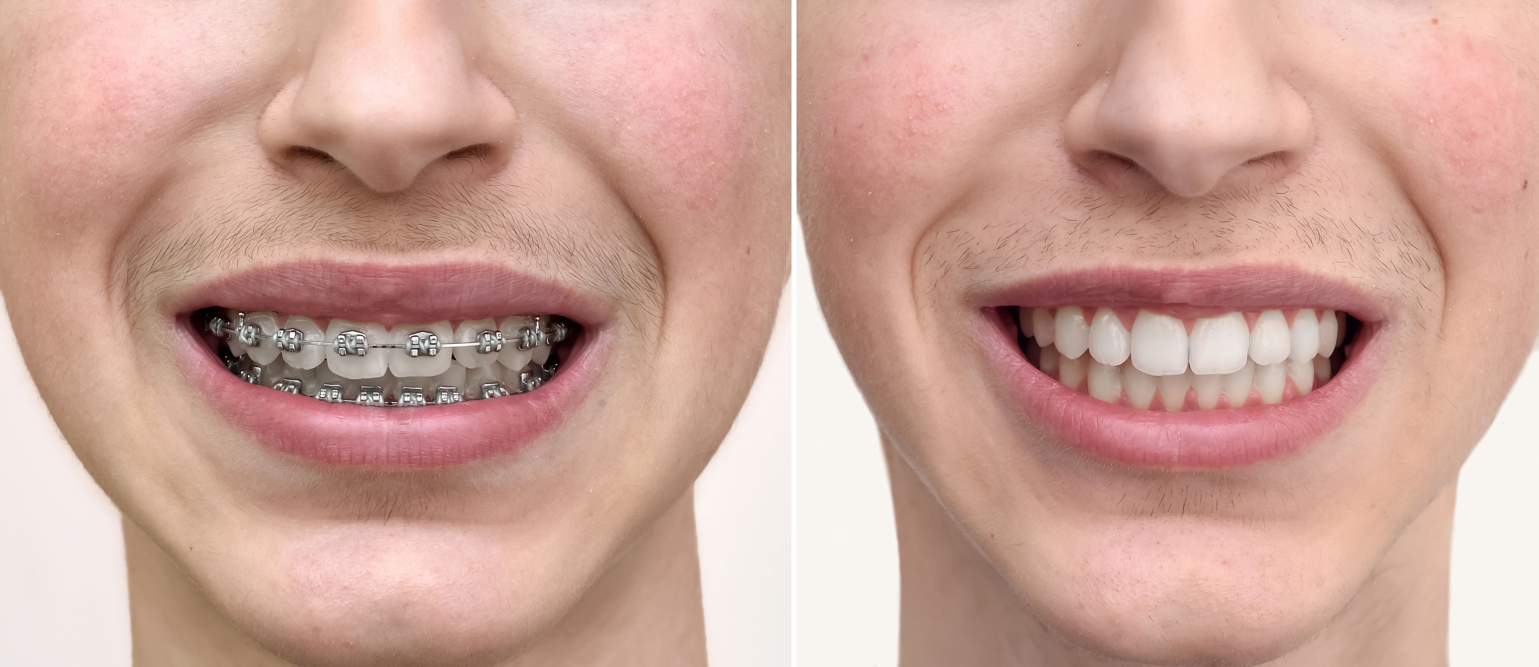 before and after braces