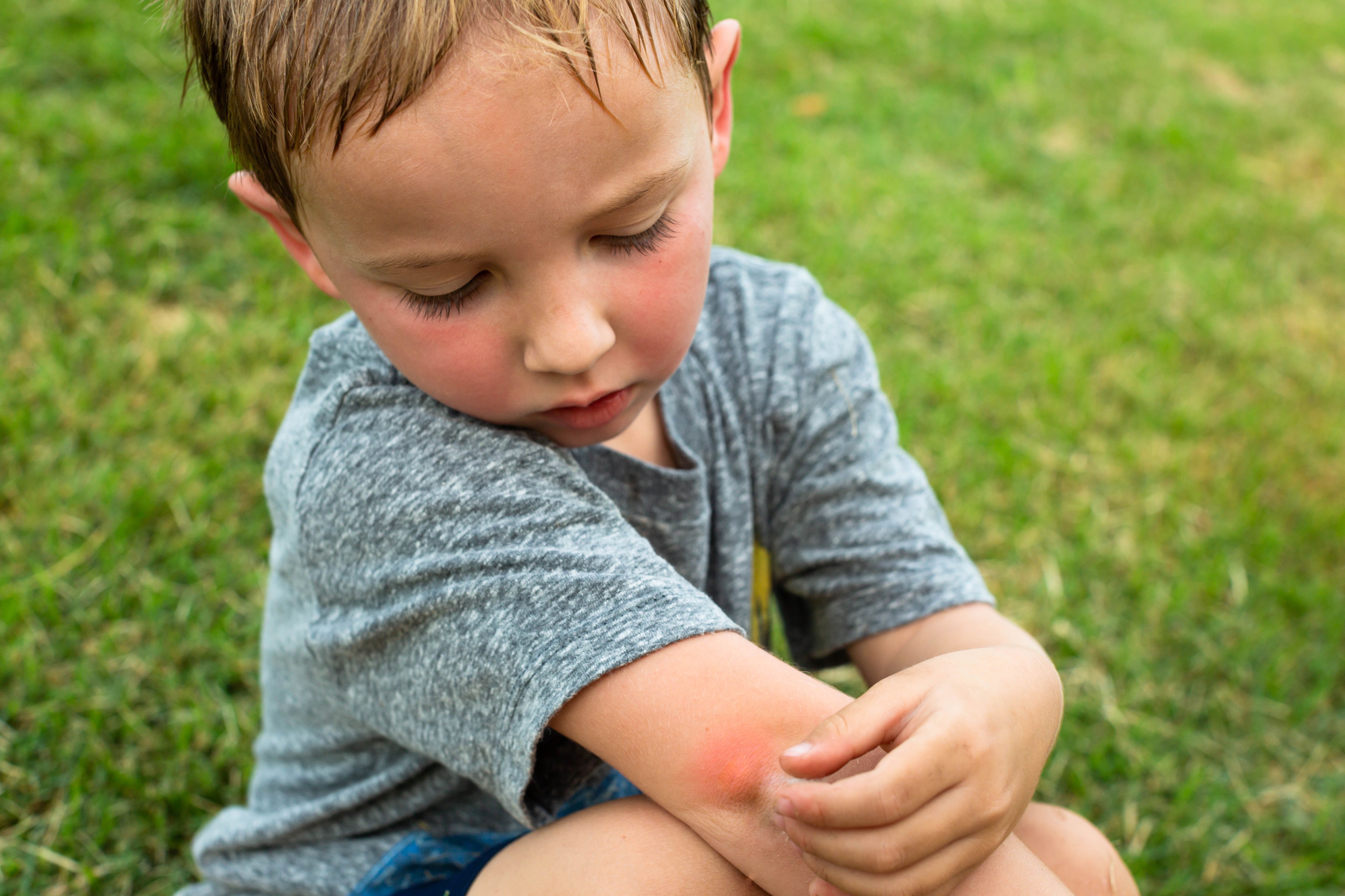 toddler skin irritation