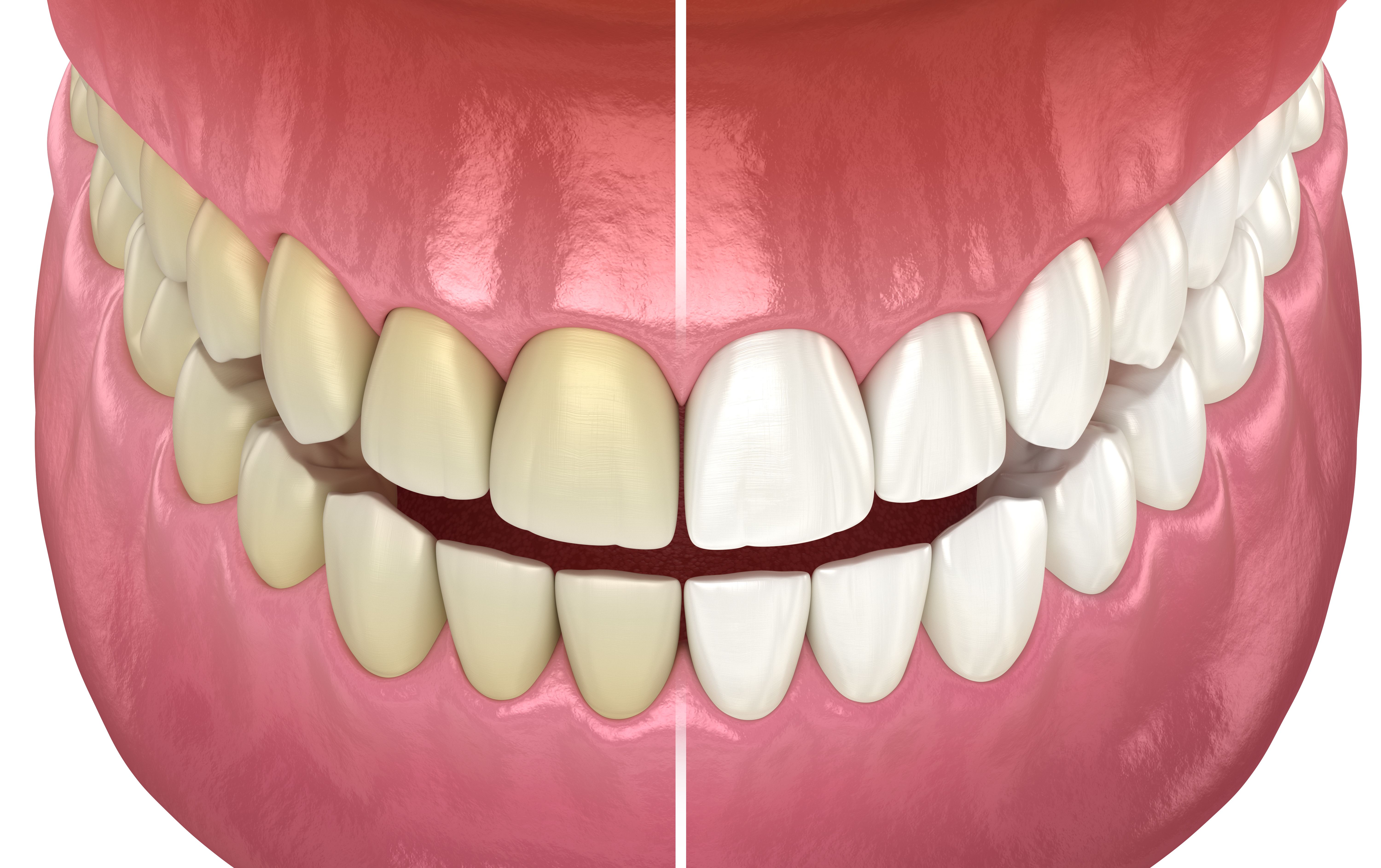 teeth whitening process
