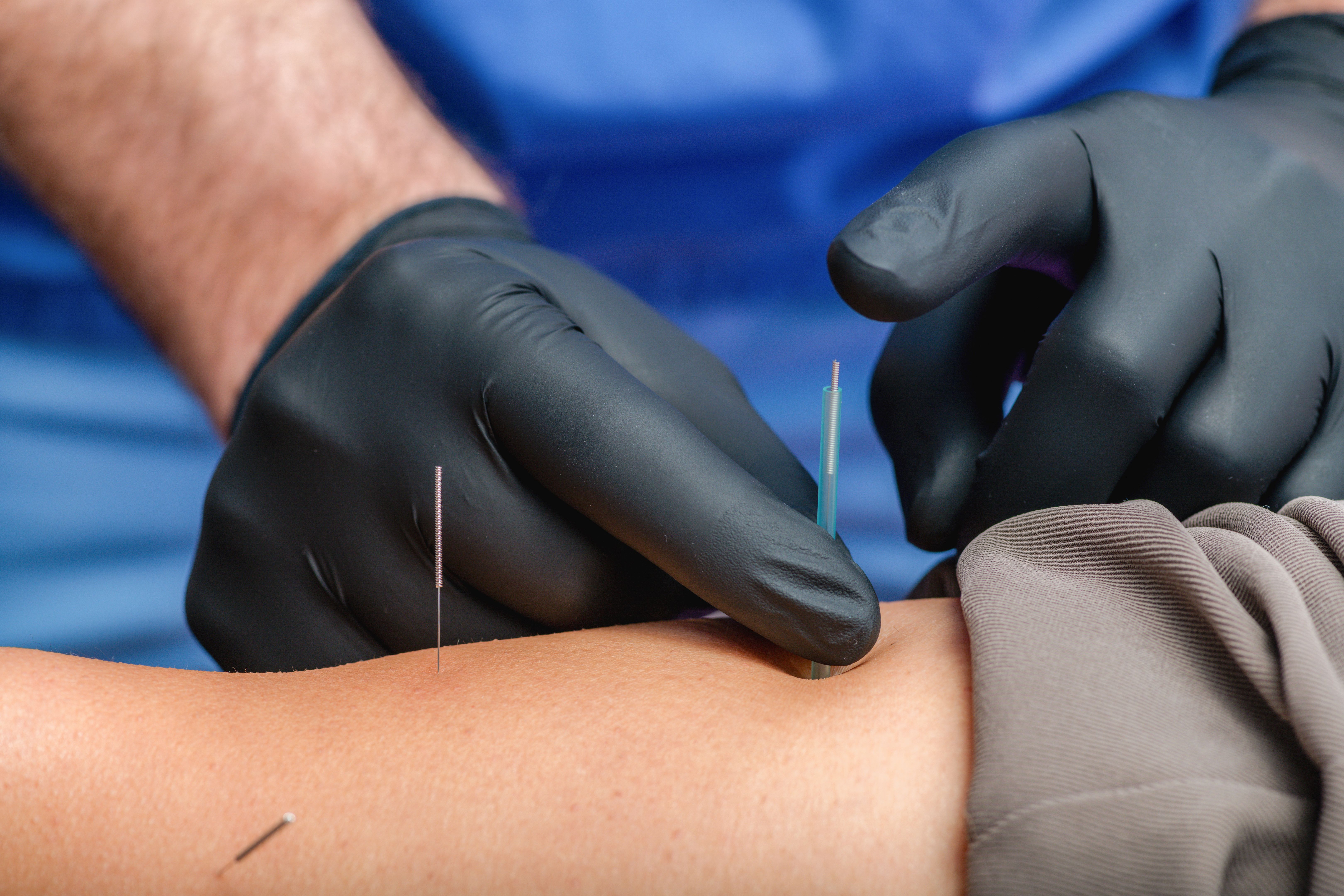 dry needling