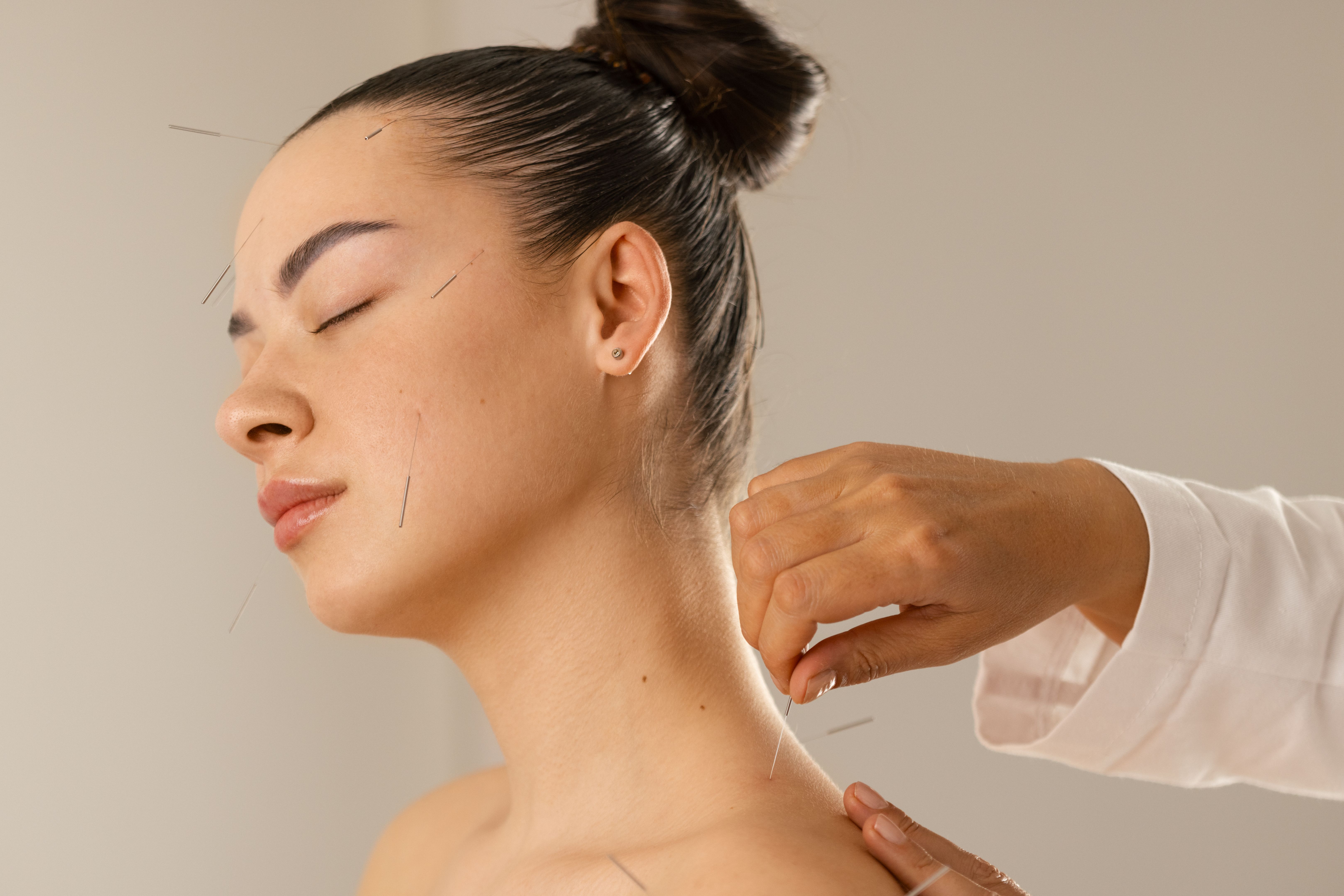 Acupuncture back and shoulder treatment, therapist and patient