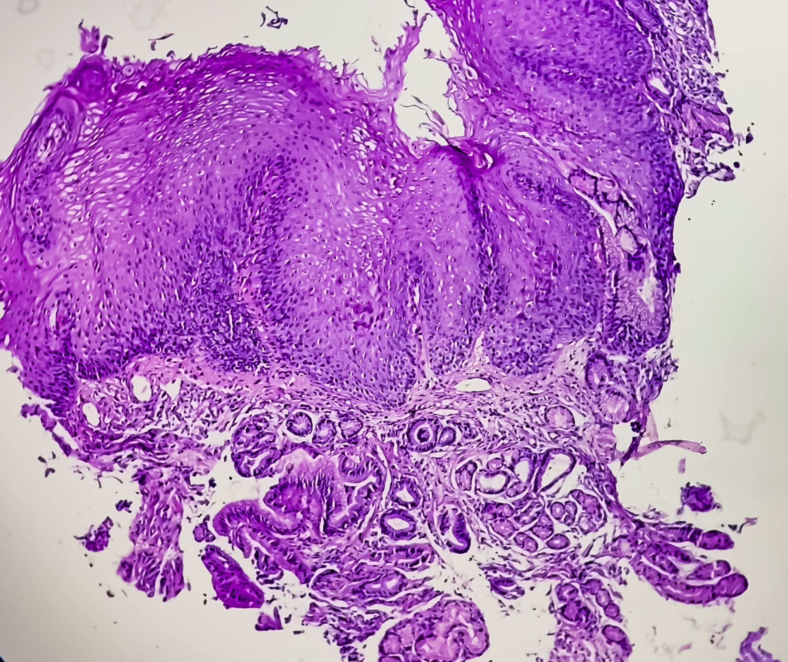endoscopic procedure