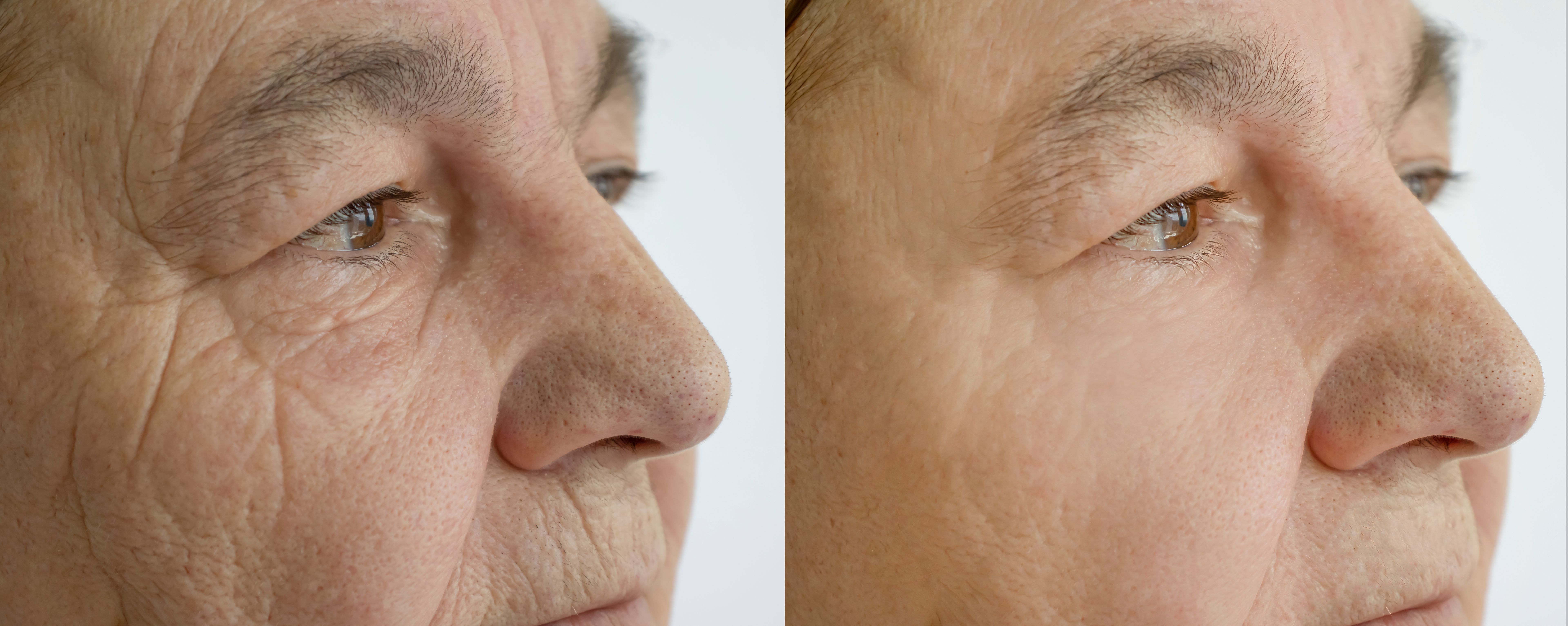 comparação tratamento veias