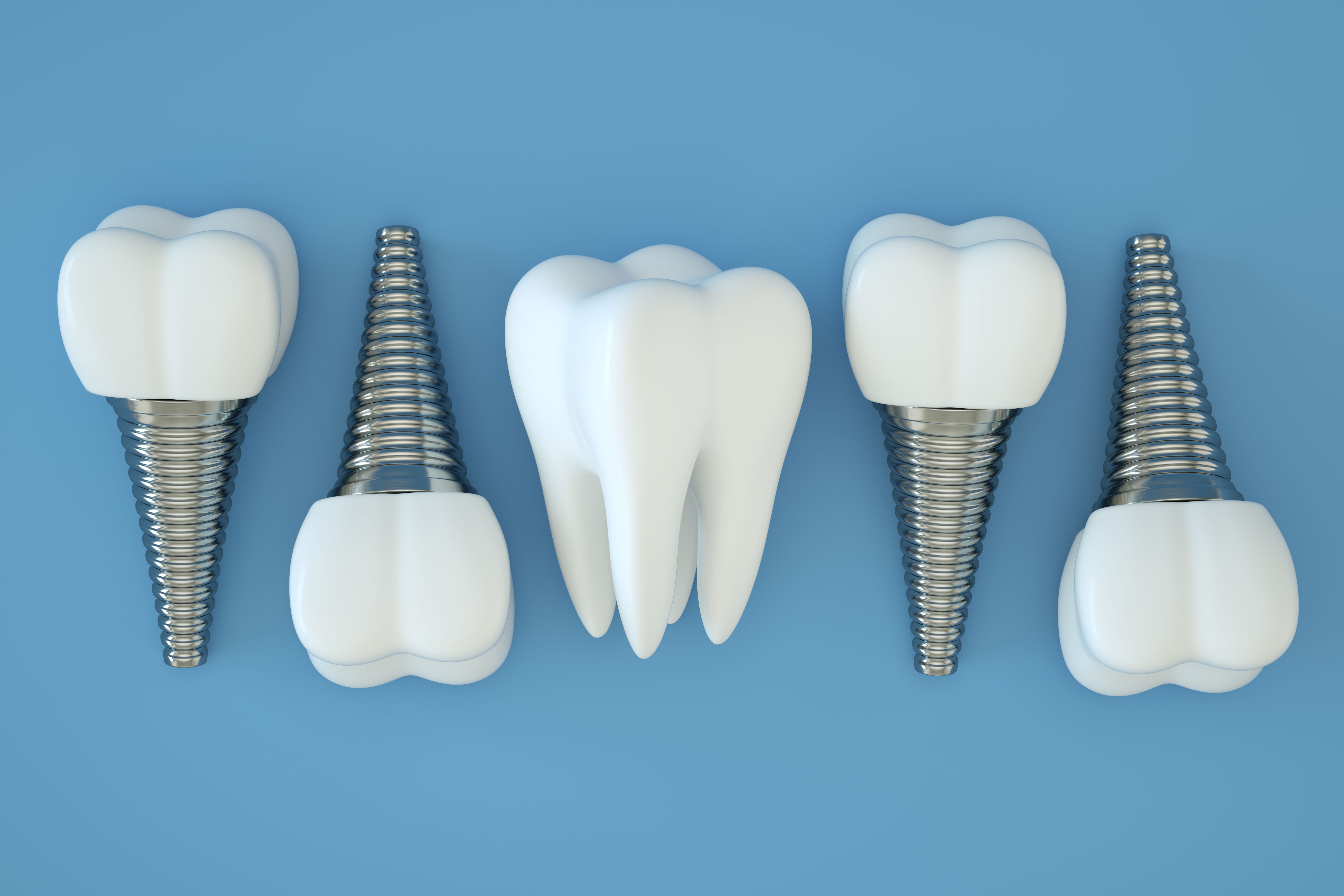 dental implant