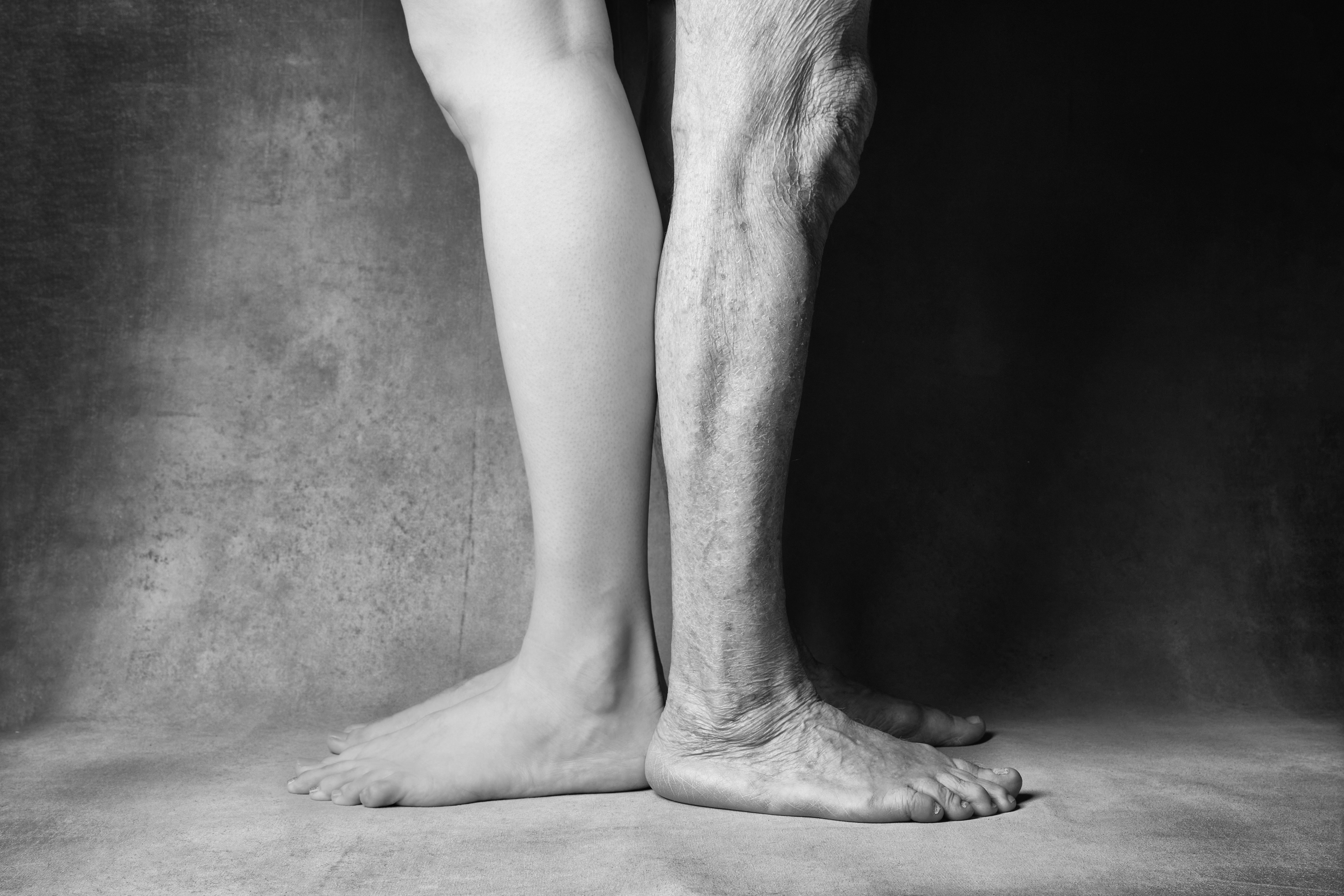 varicose veins
