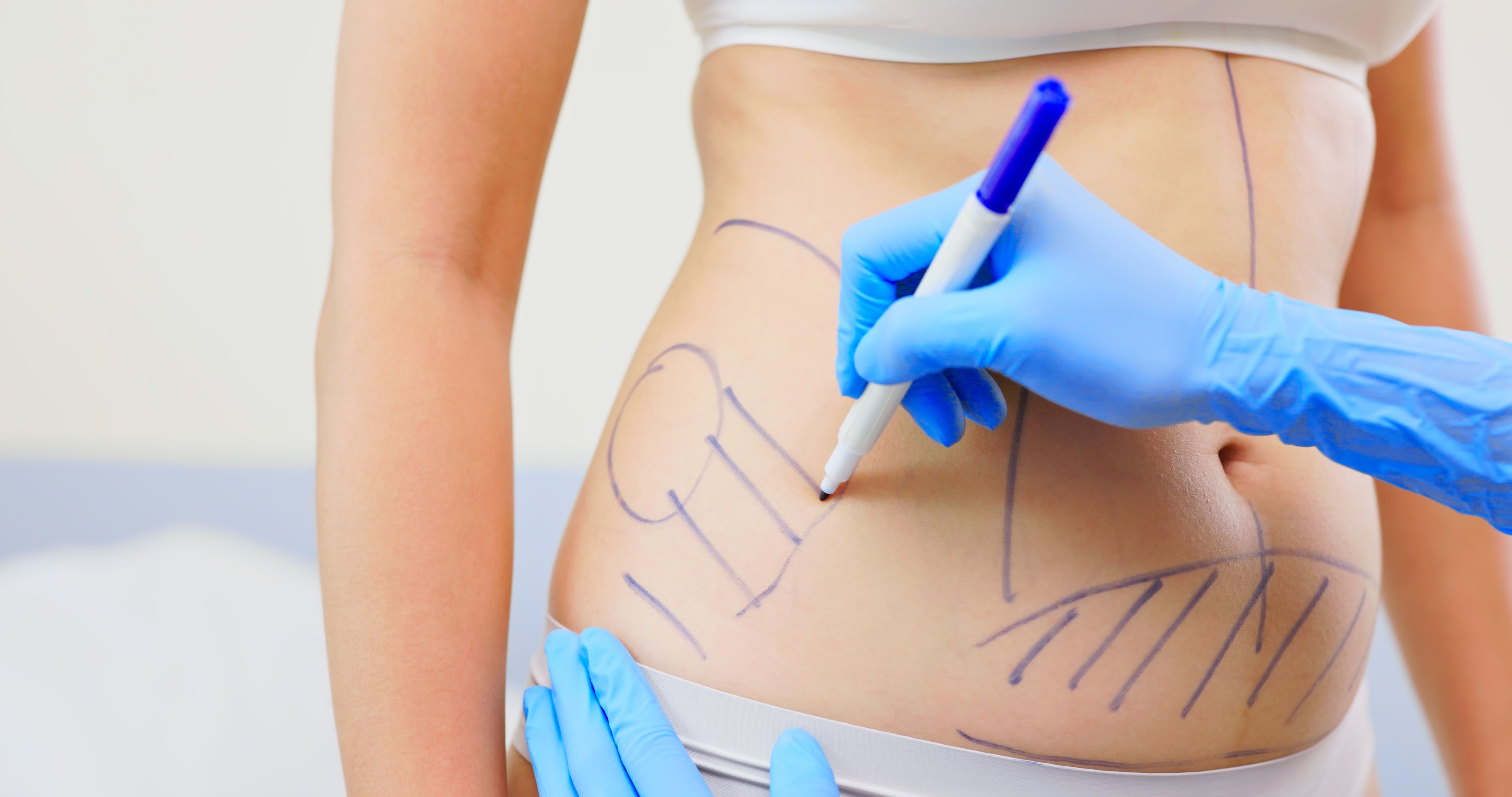 liposuction procedure