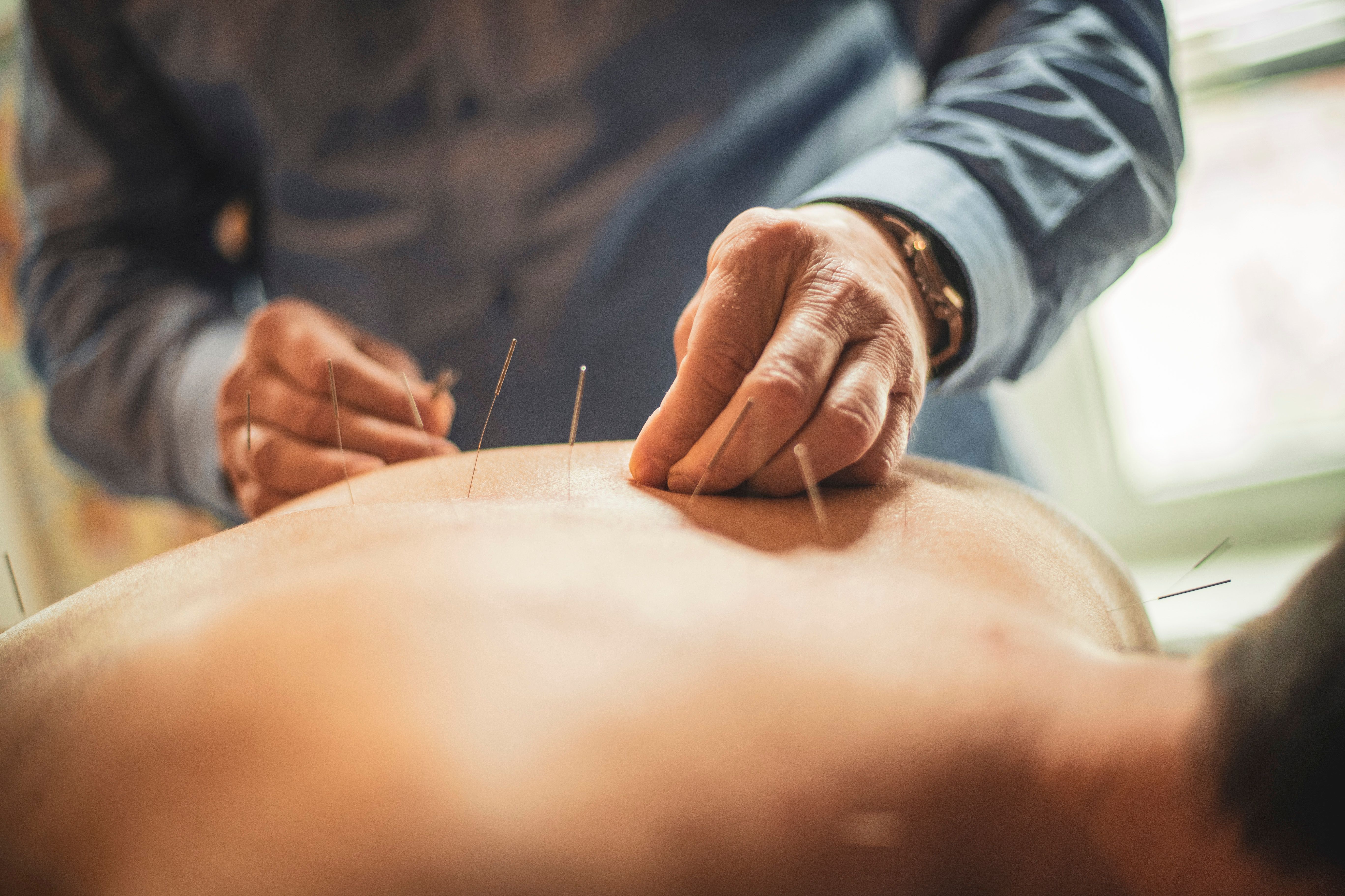 acupuncture benefits