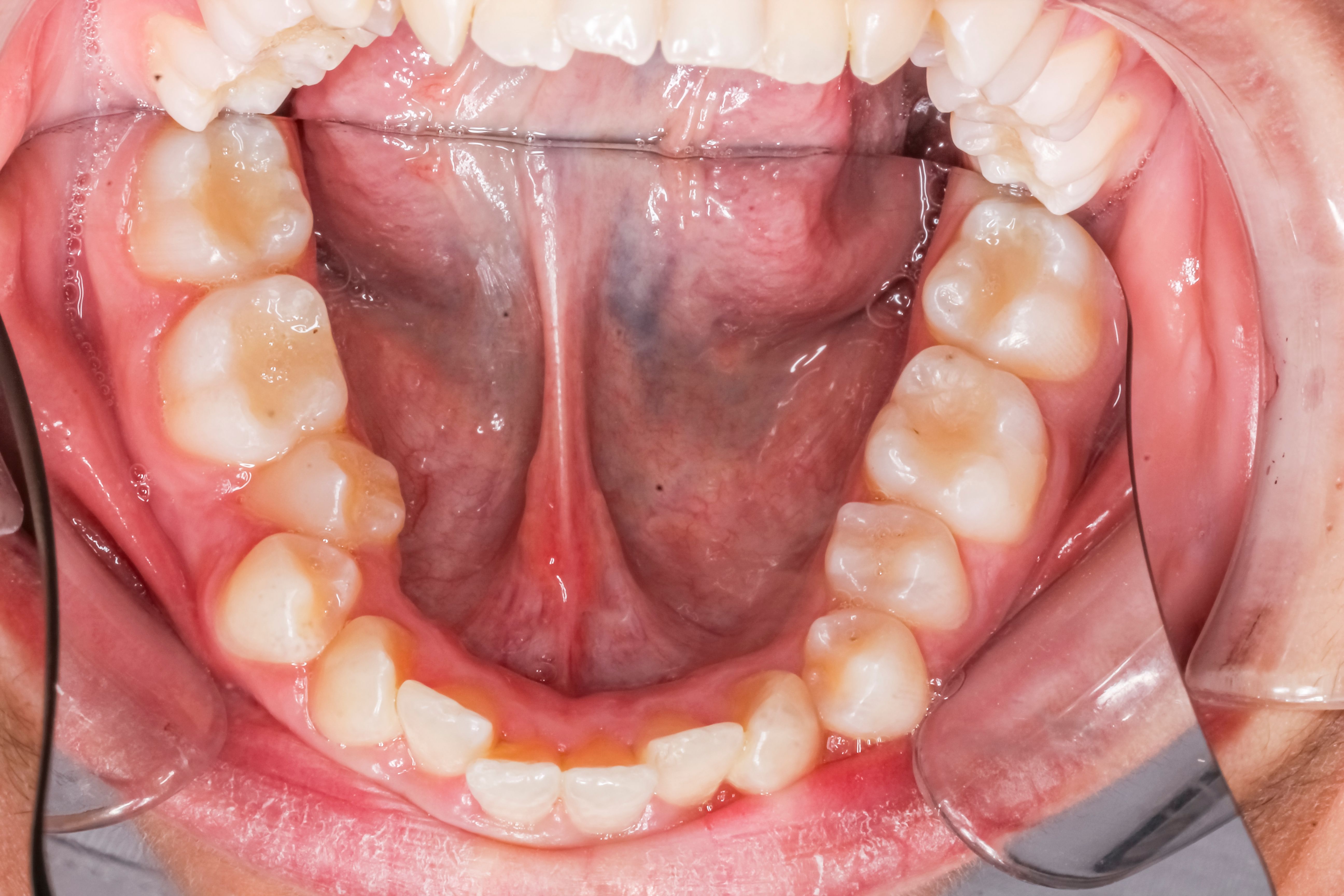 Dentistry case with unstraightened crooked healthy teeth with no decay.