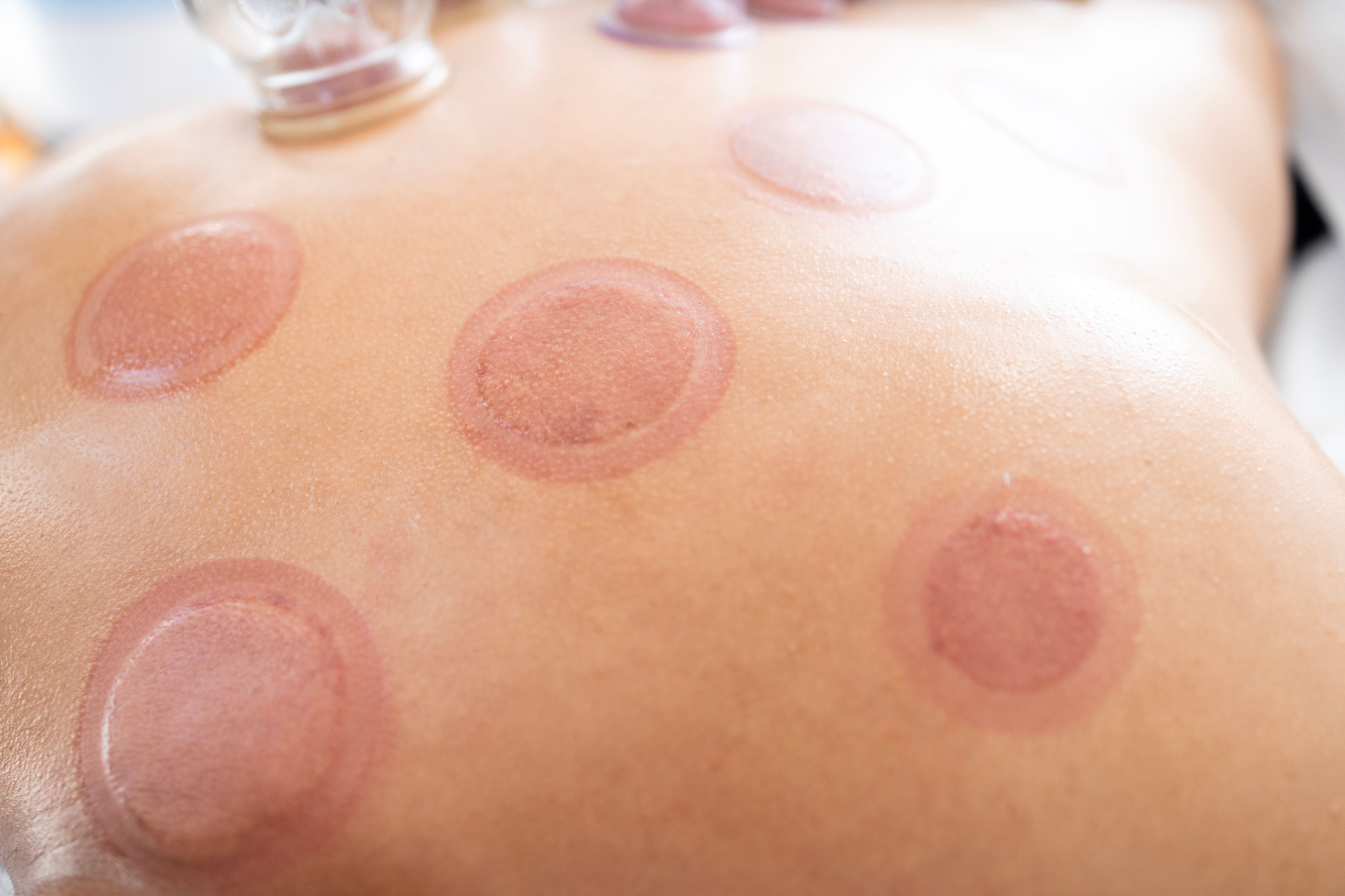 cupping therapy