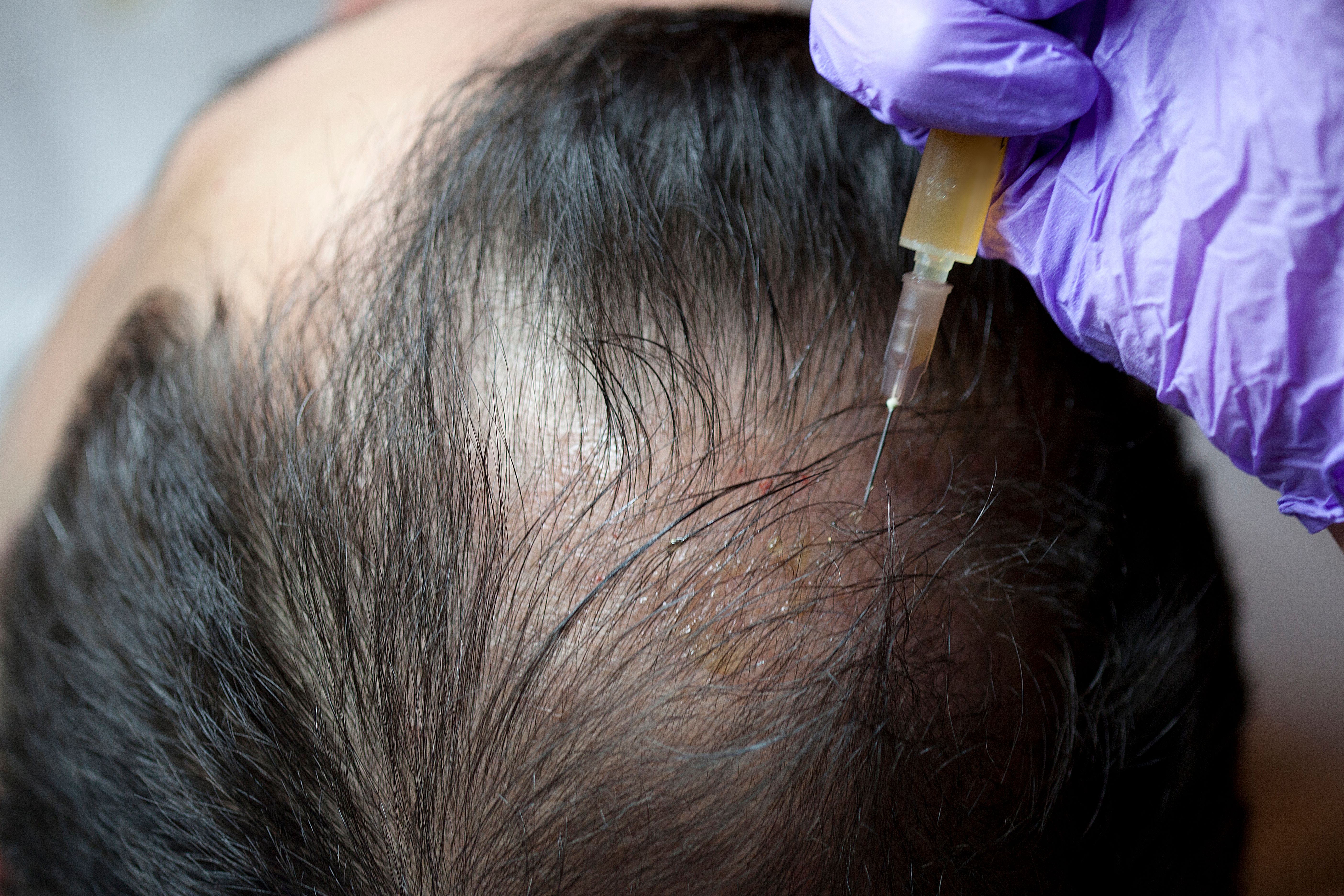 Prp treatment hair loss leicester Prp treatment hair loss leicester
