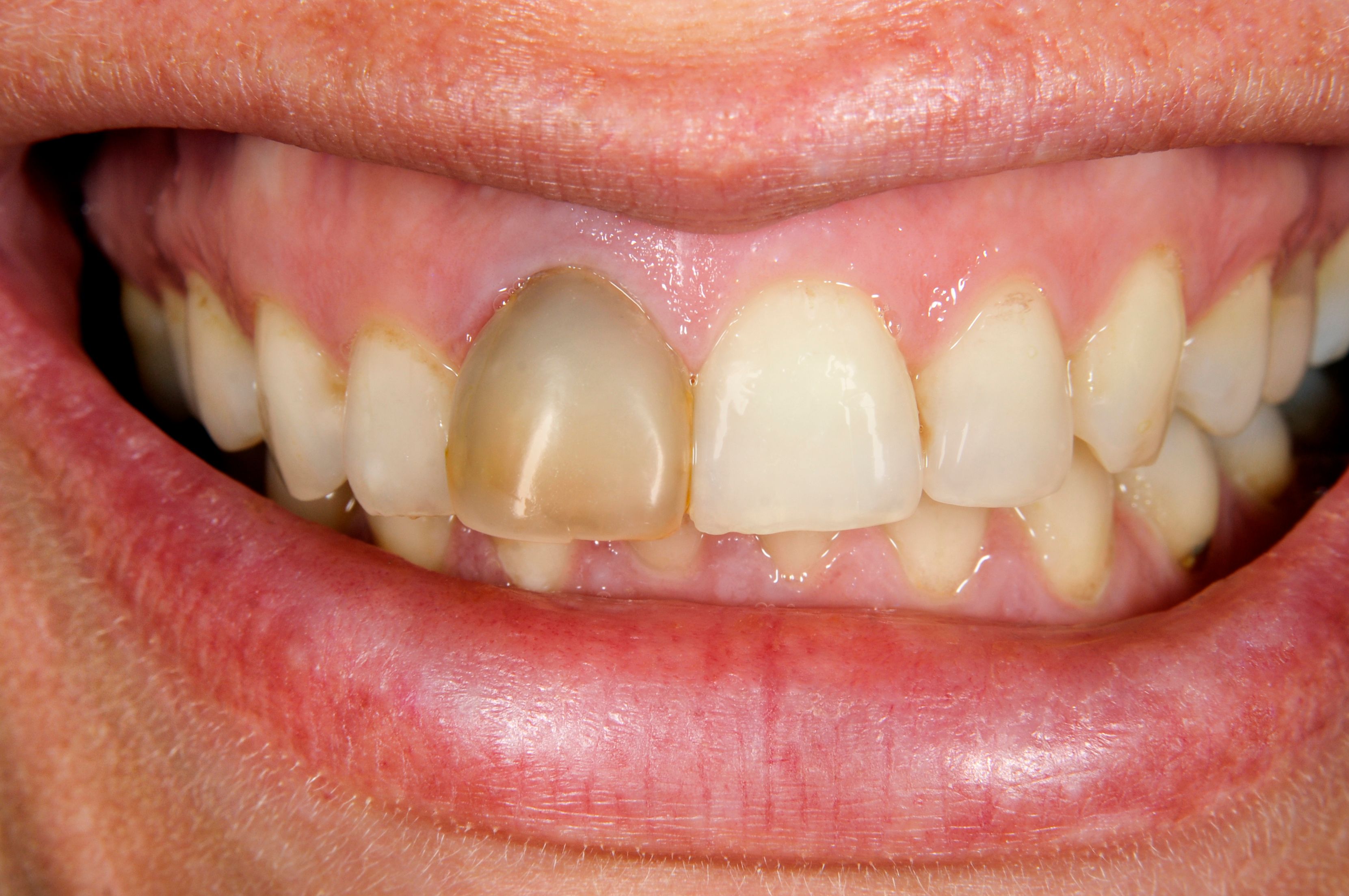 teeth discoloration