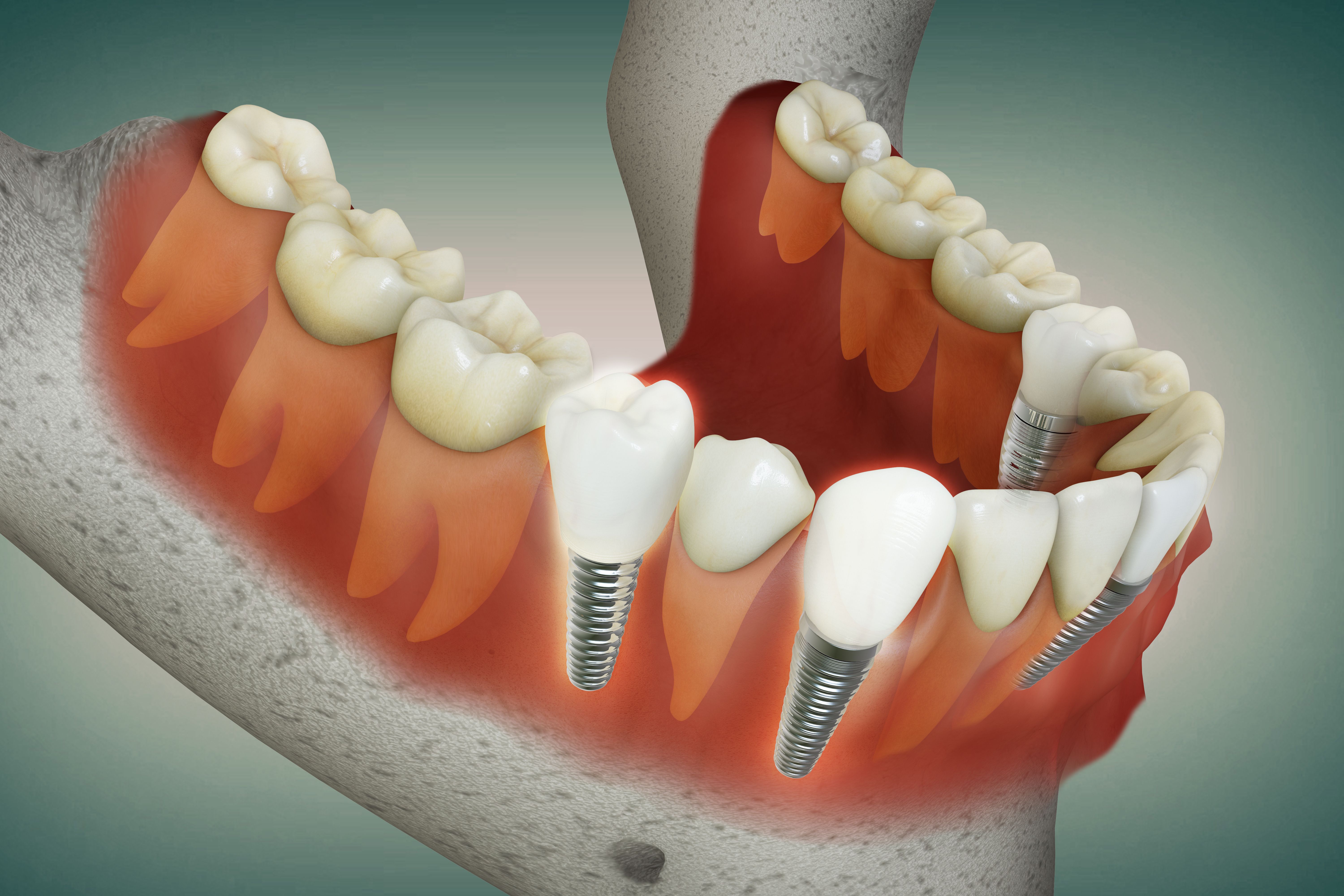 dental implants