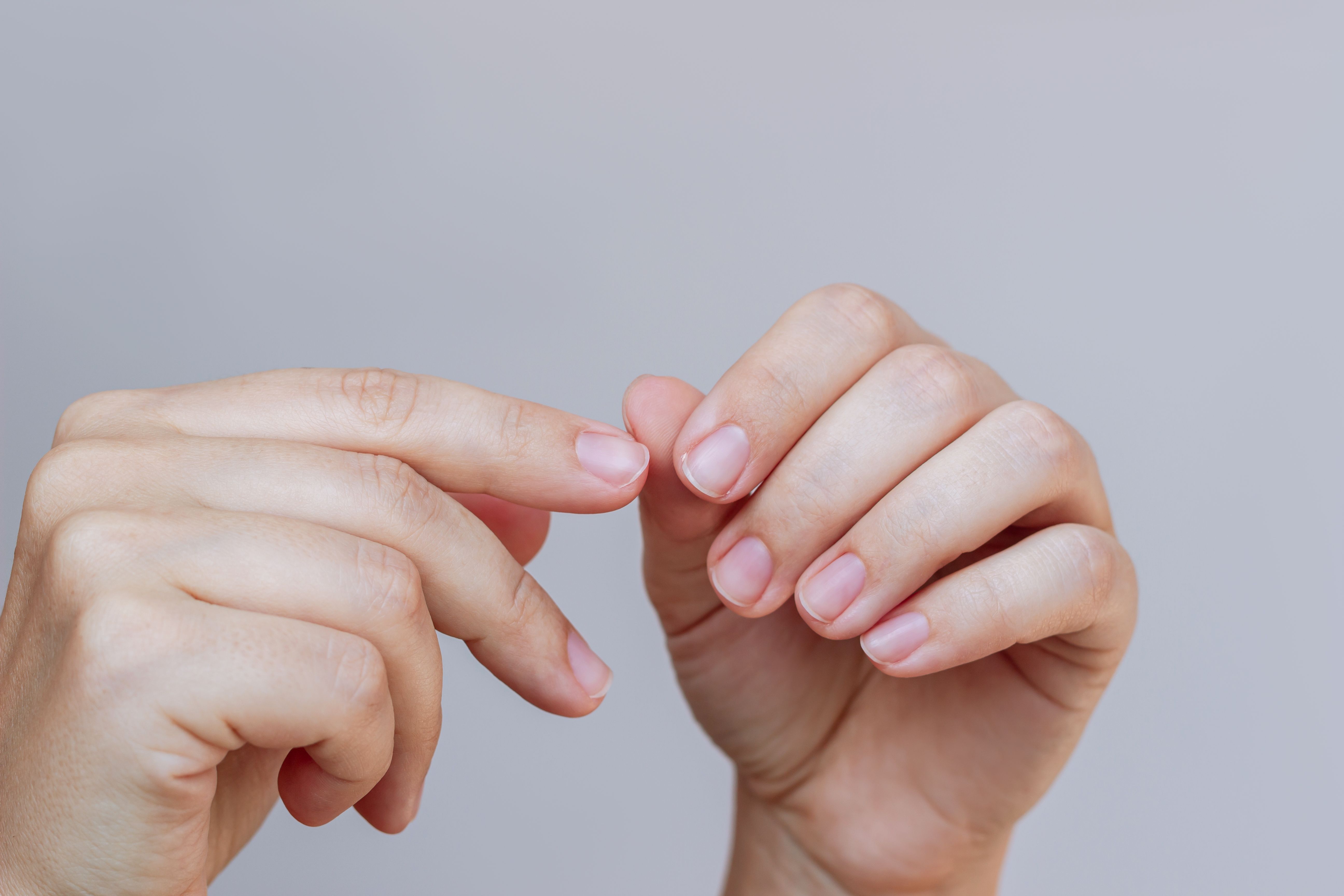 Young woman's hand pointing to the burr on the finger near the nail. Agnail, hangnail, cuticles