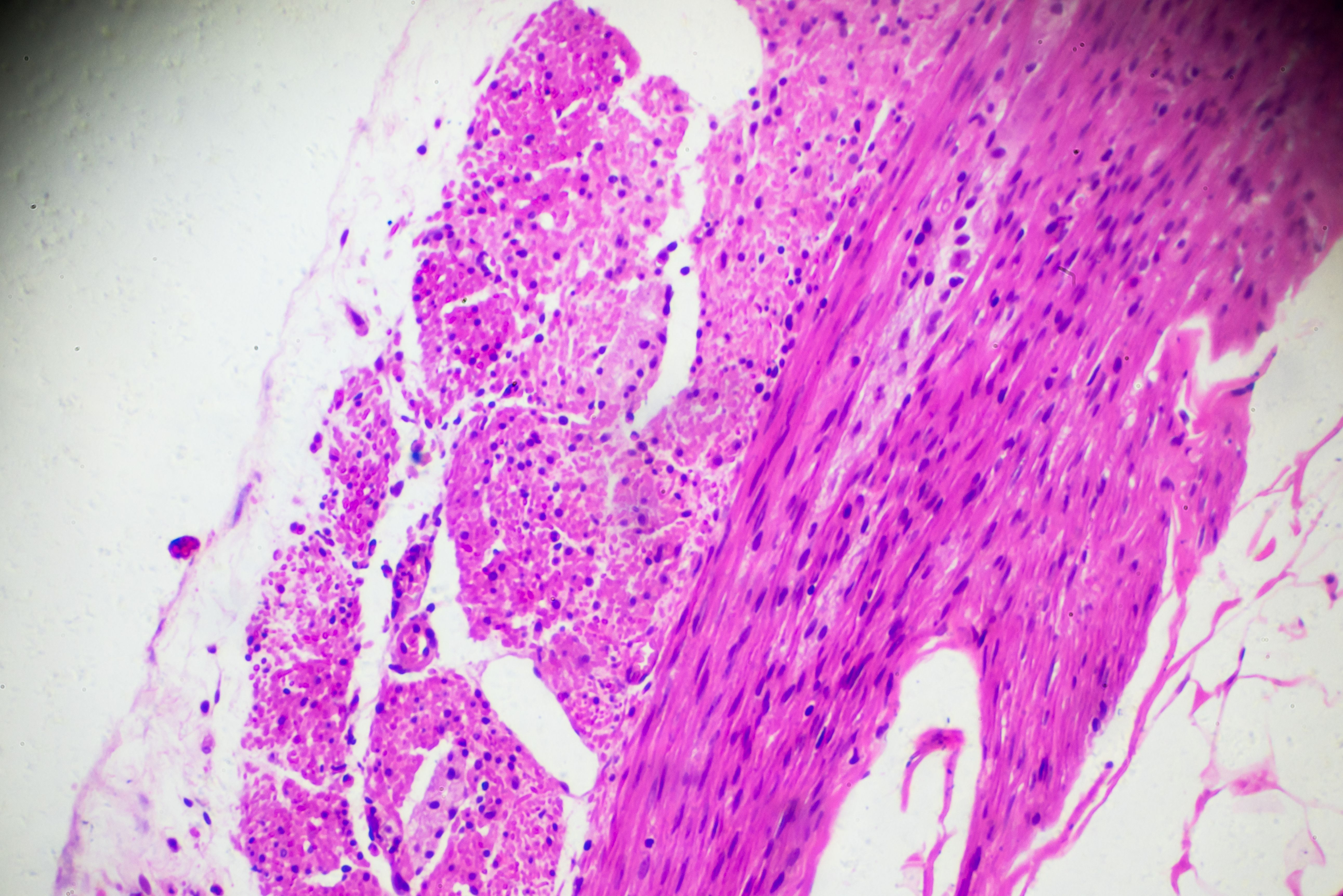 tomosynthesis mammography
