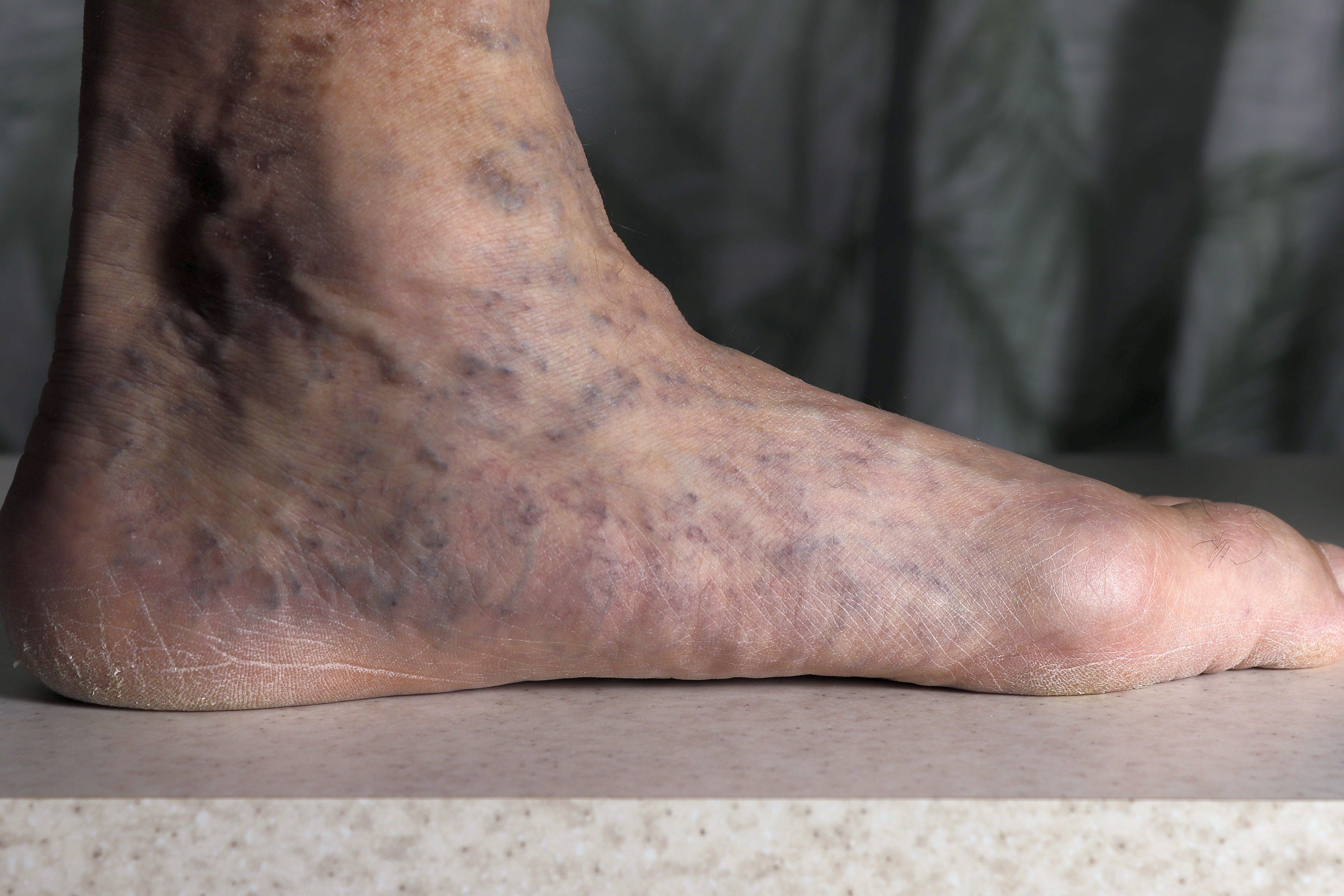 causes of varicose veins