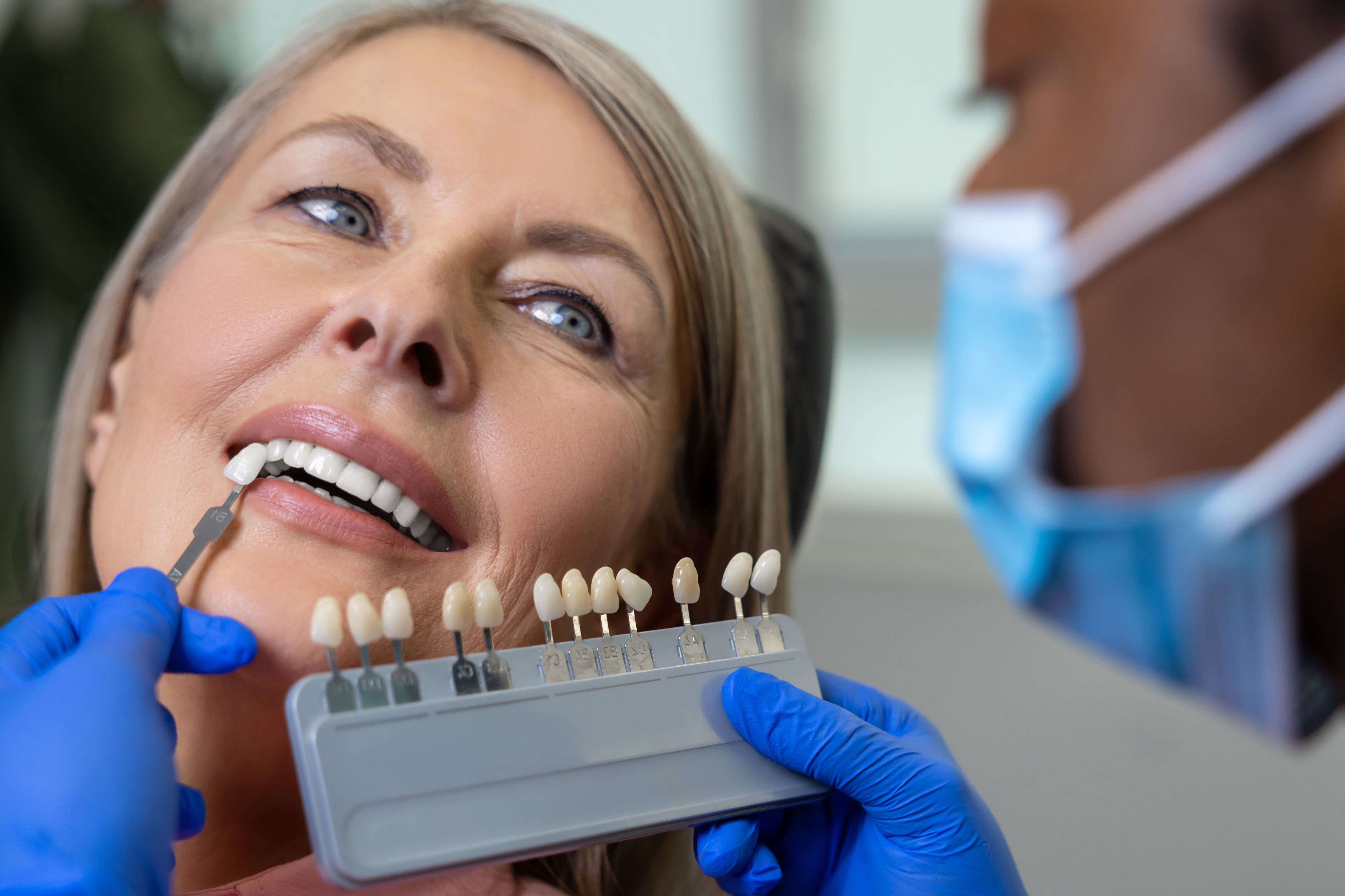 veneers